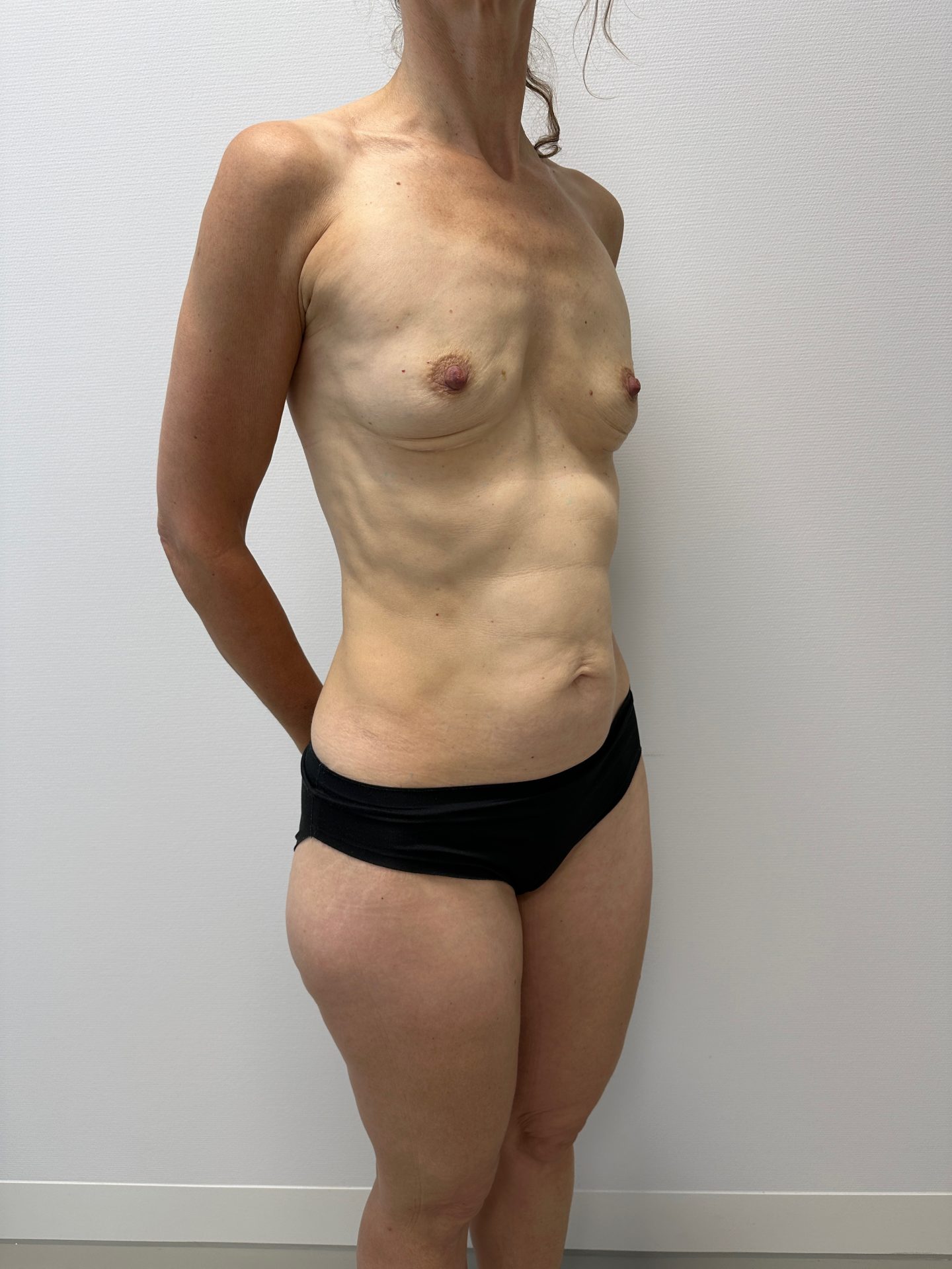 Lipofilling before