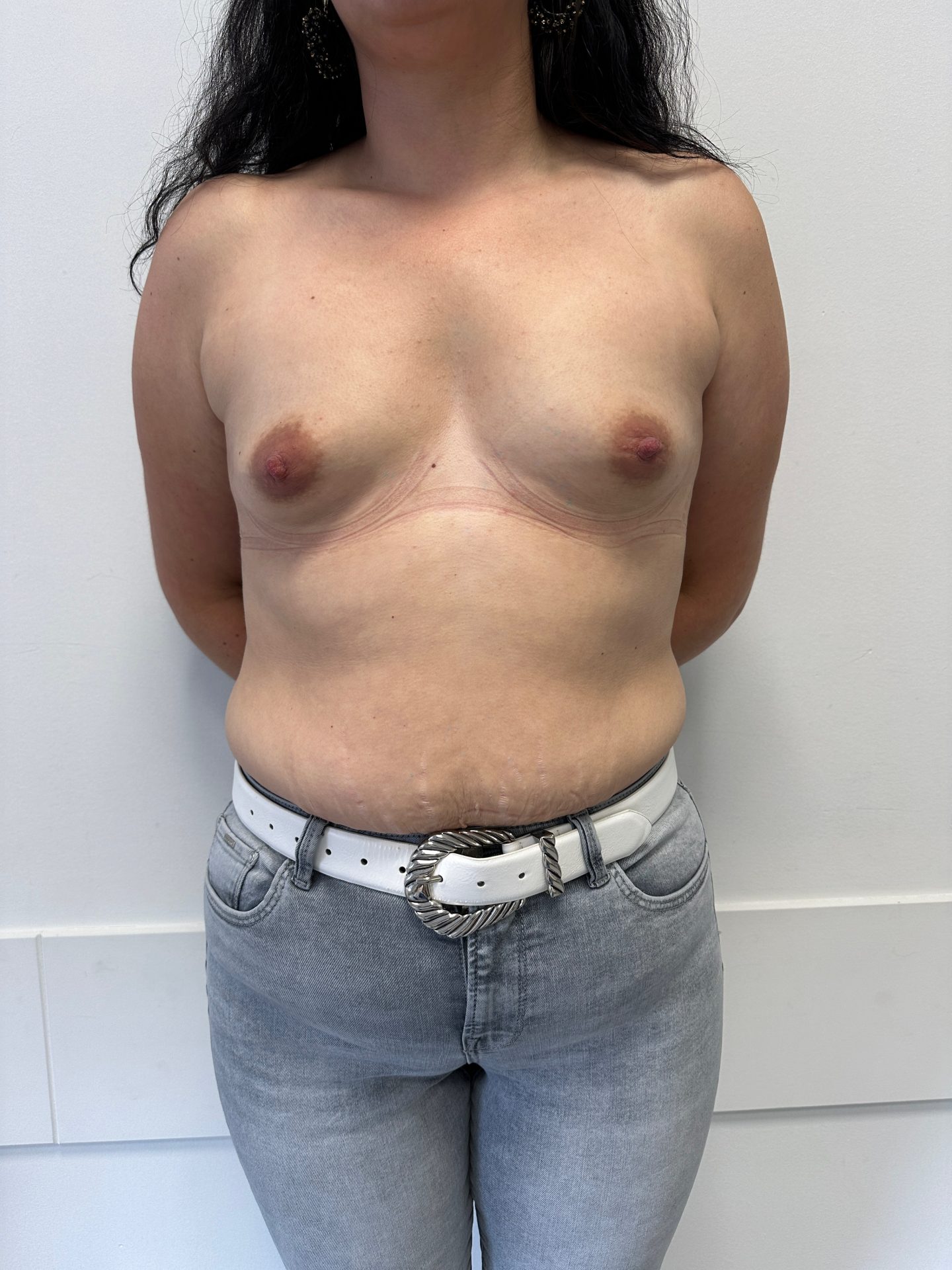 Breast augmentation before