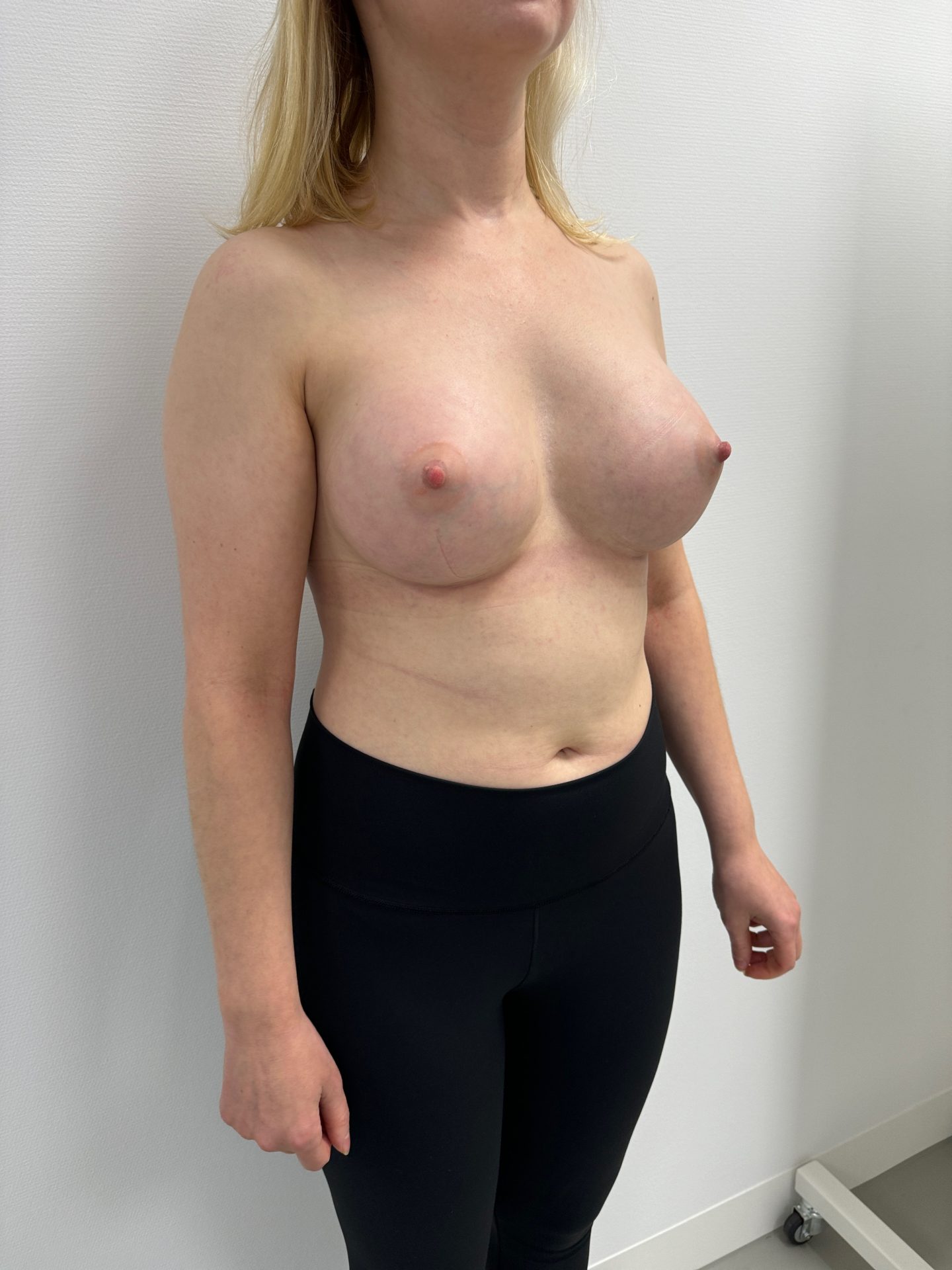 Breast augmentation after