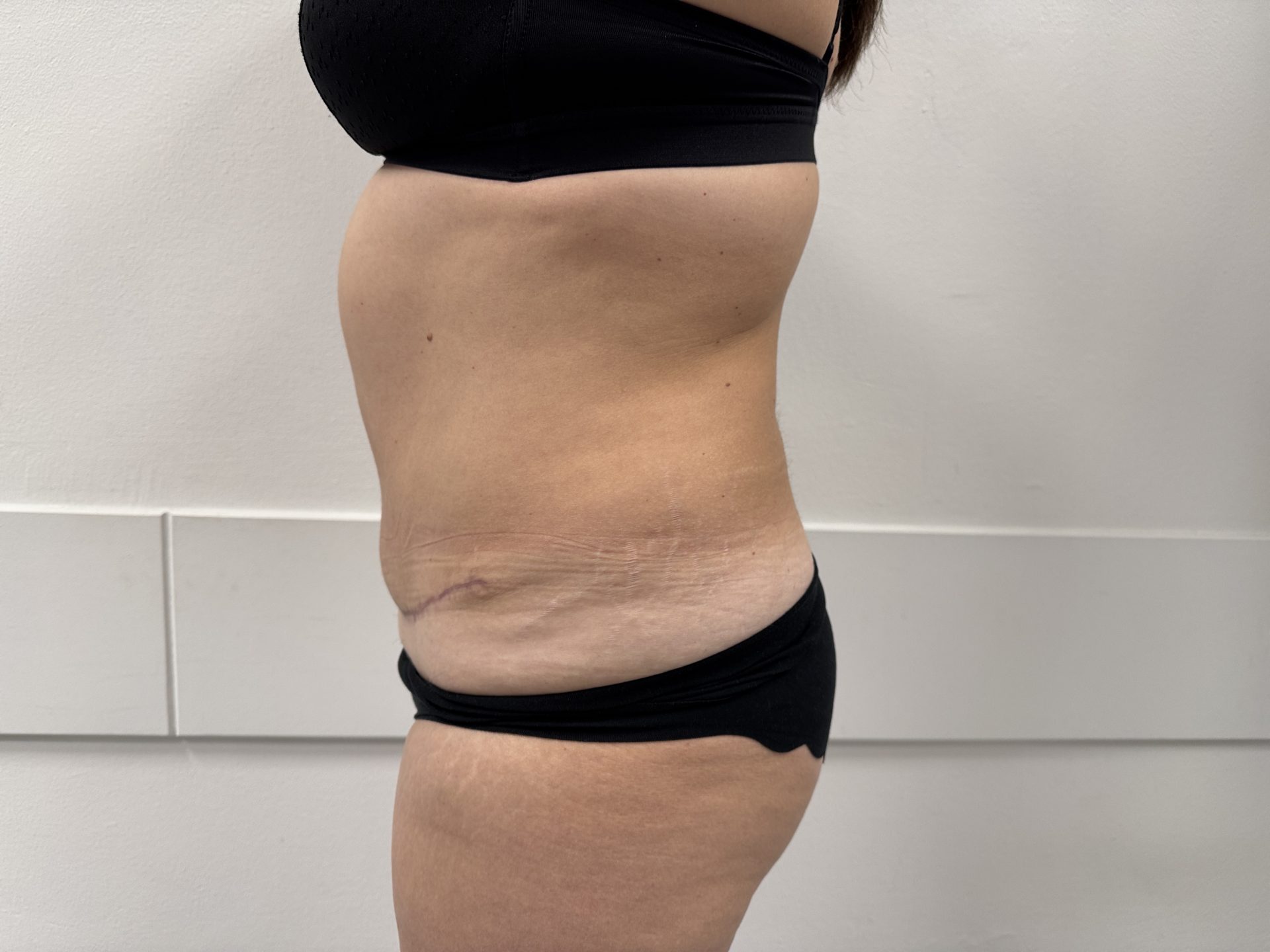 Tummy tuck after