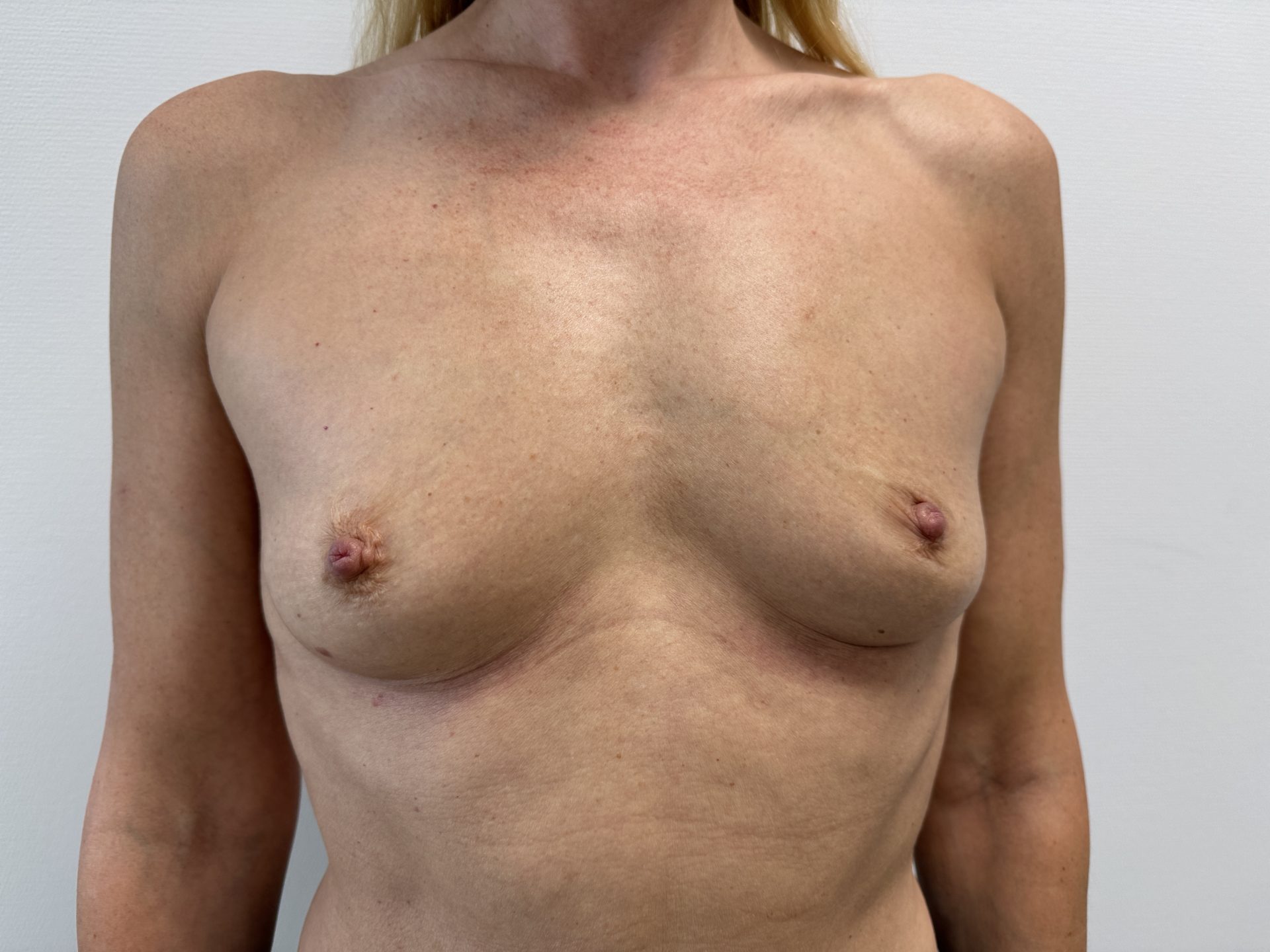 Breast augmentation before