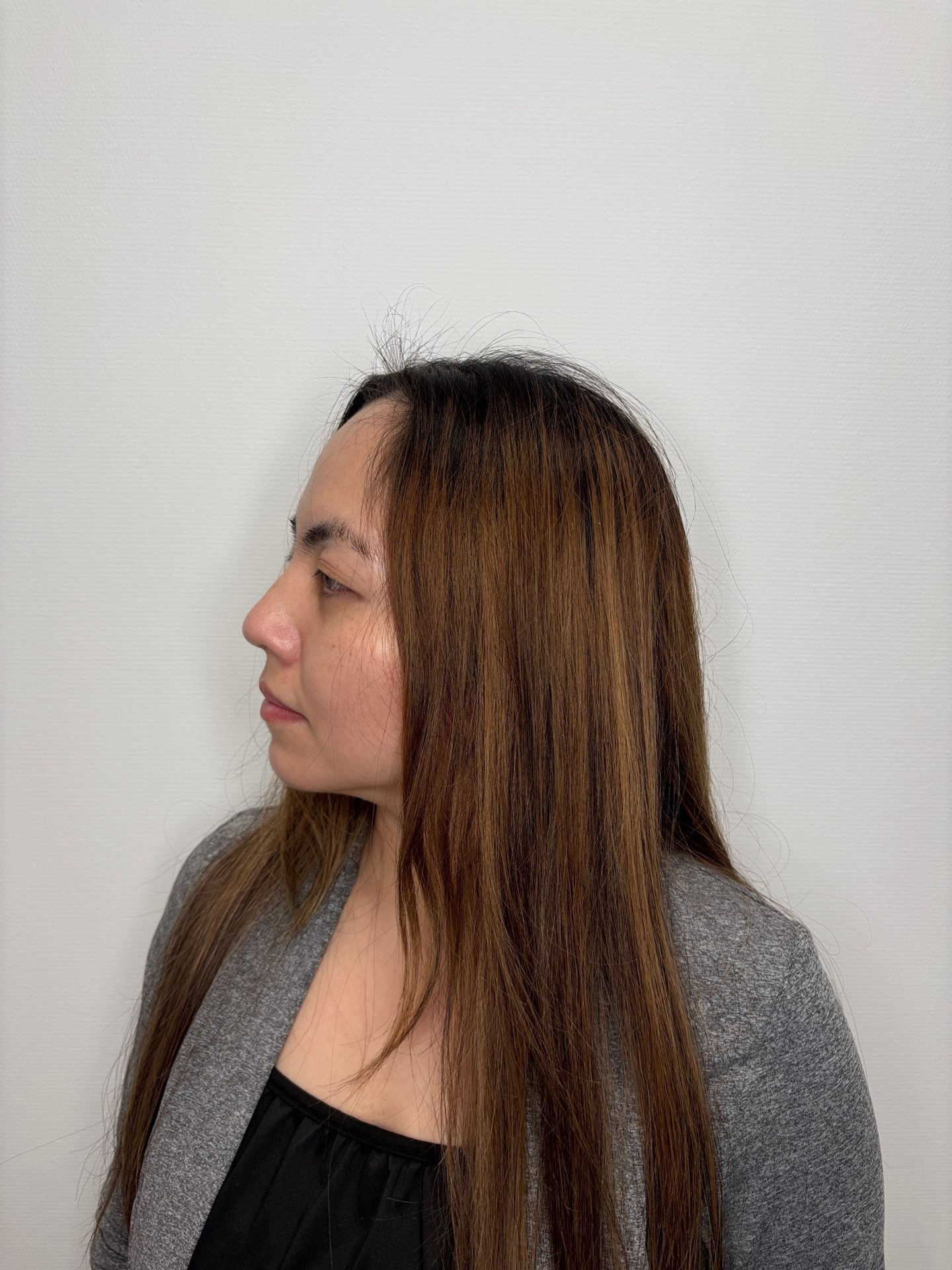 Nose correction after