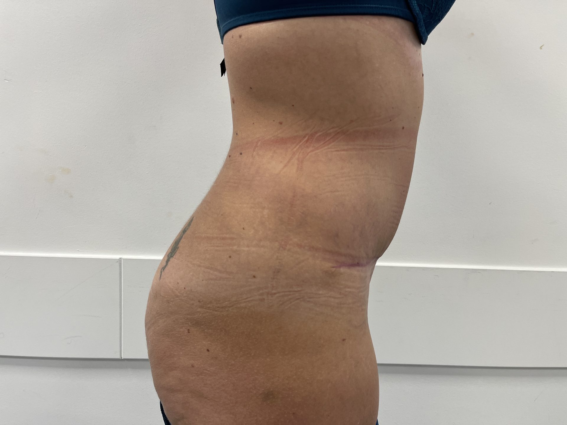 Tummy tuck after