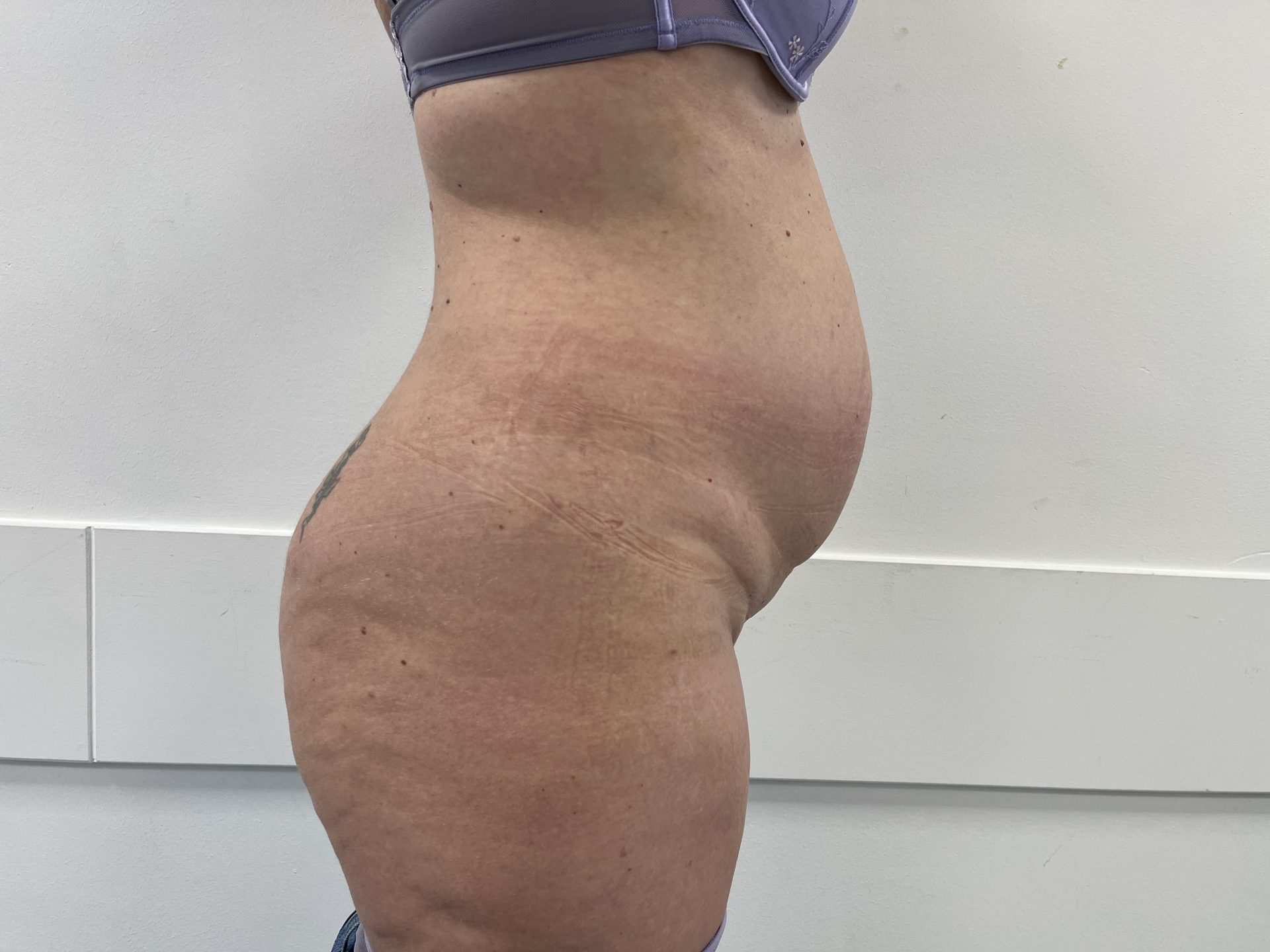 Tummy tuck before