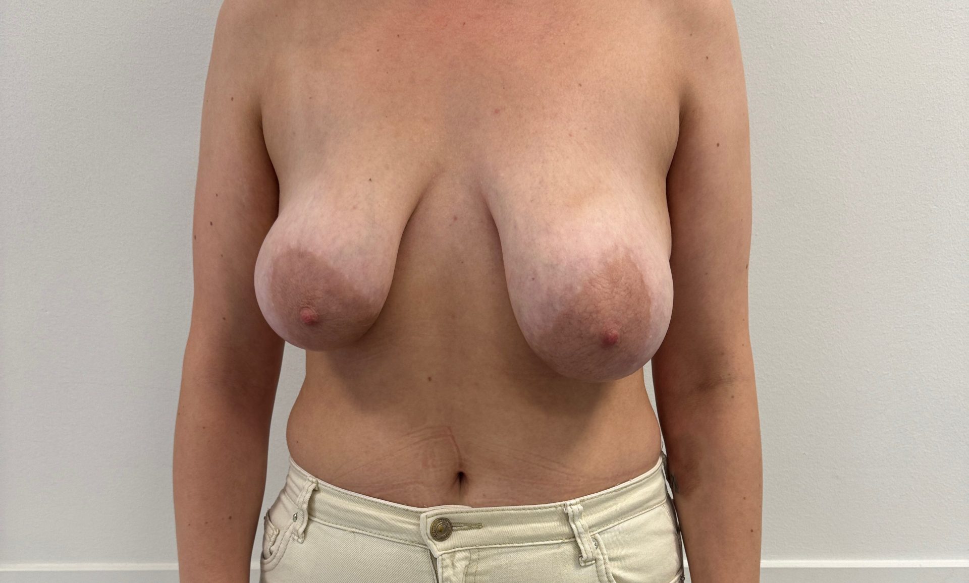 Breast reduction before