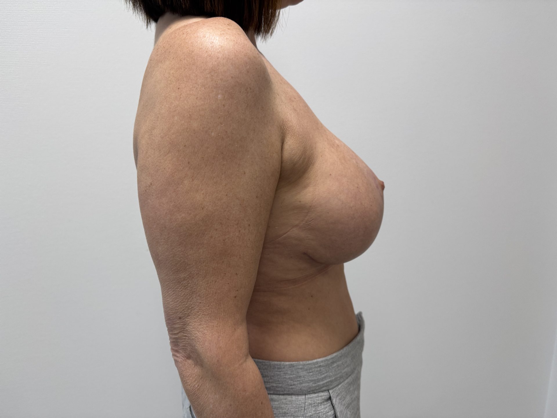 Breast lift after