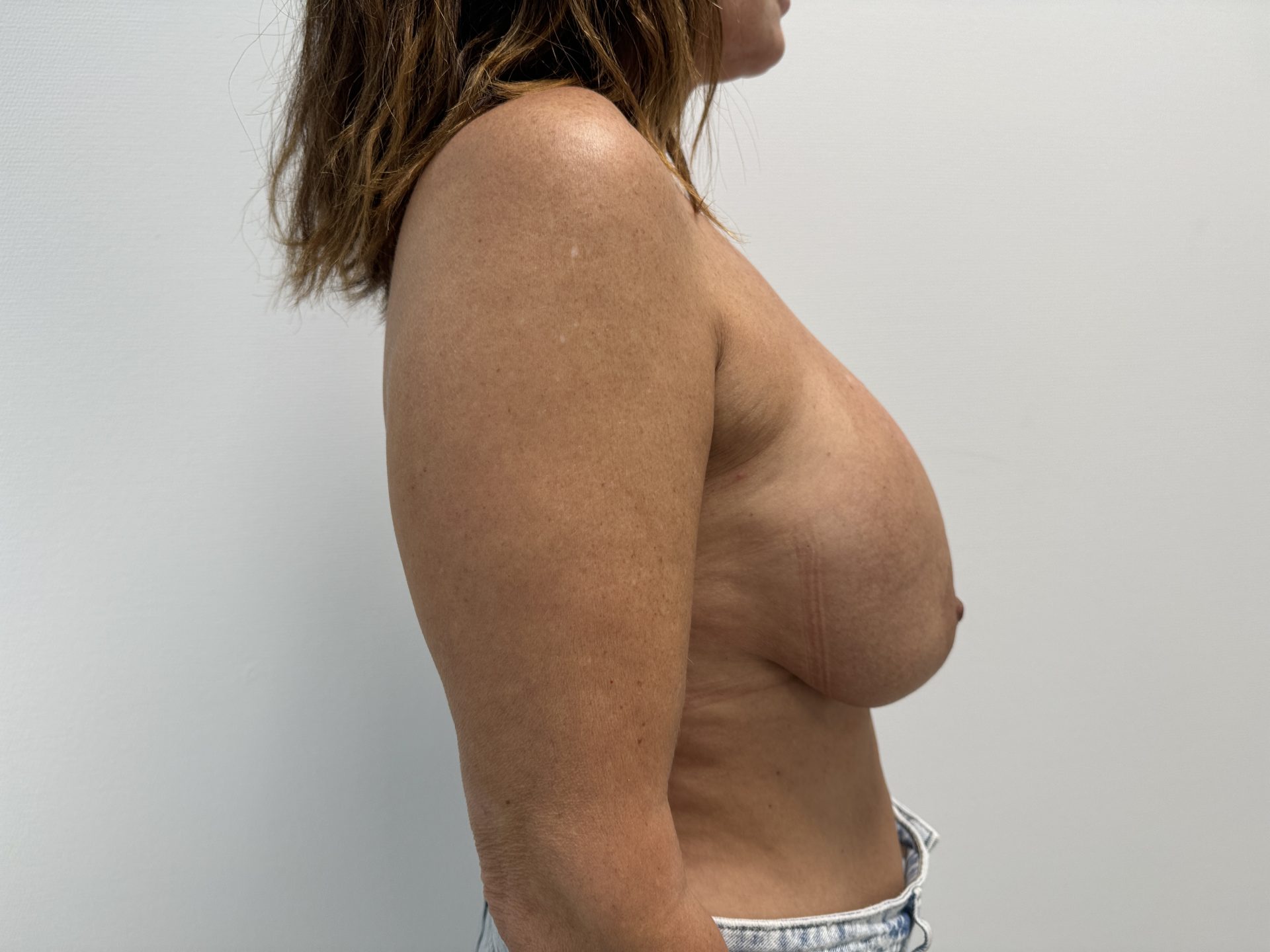 Breast lift before