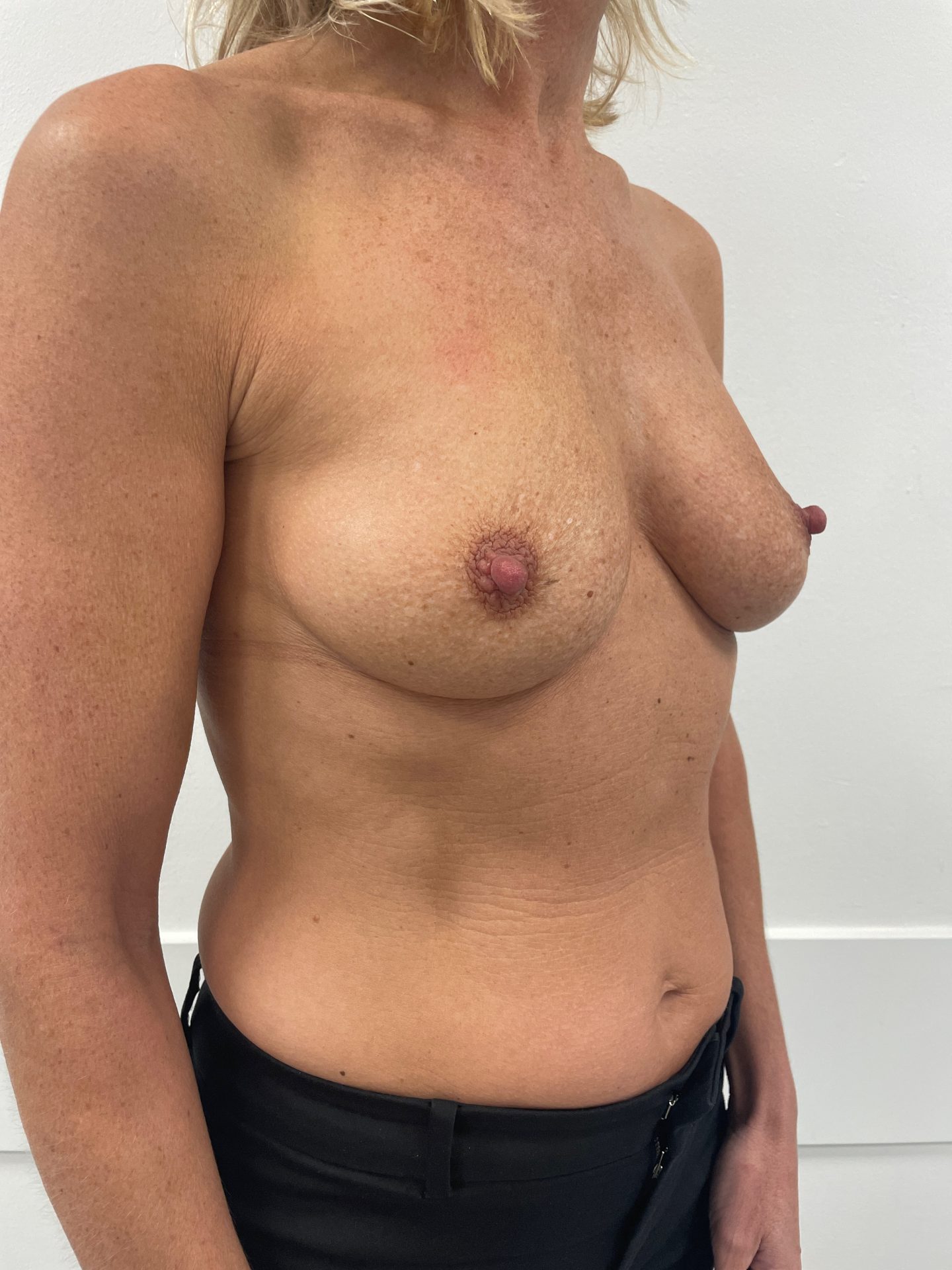 Breast augmentation before