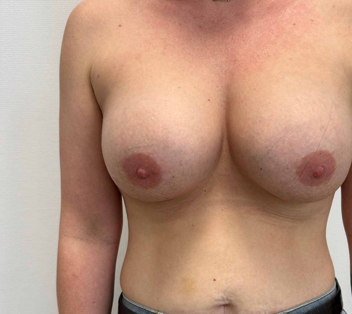Breast augmentation after