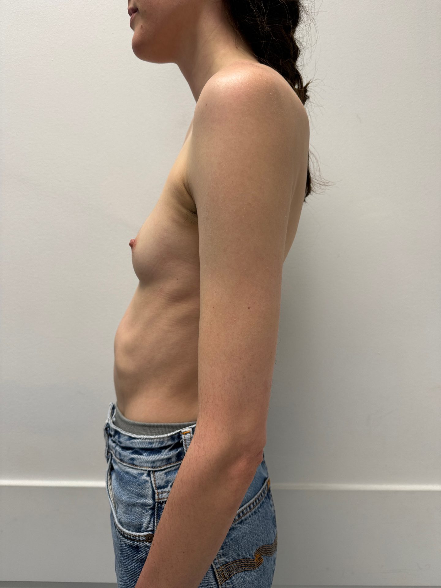 Breast augmentation before