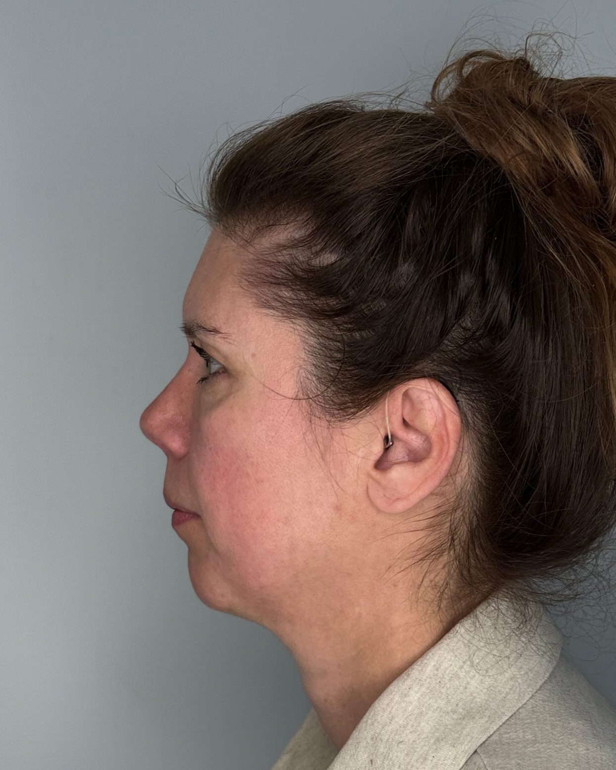 Nose correction after