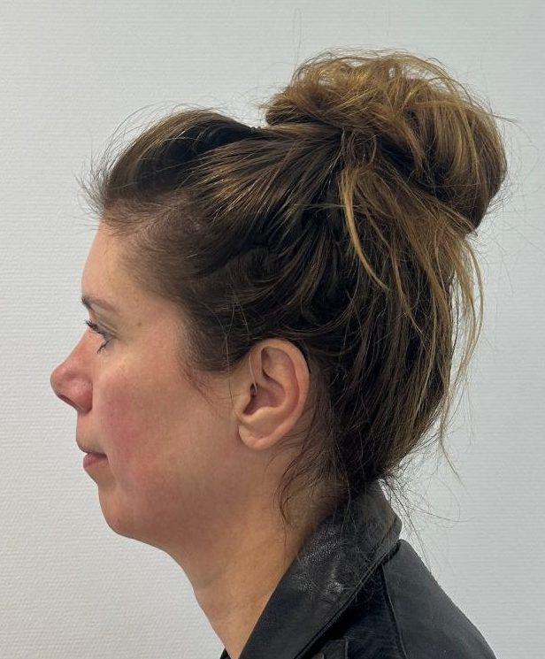 Nose correction before