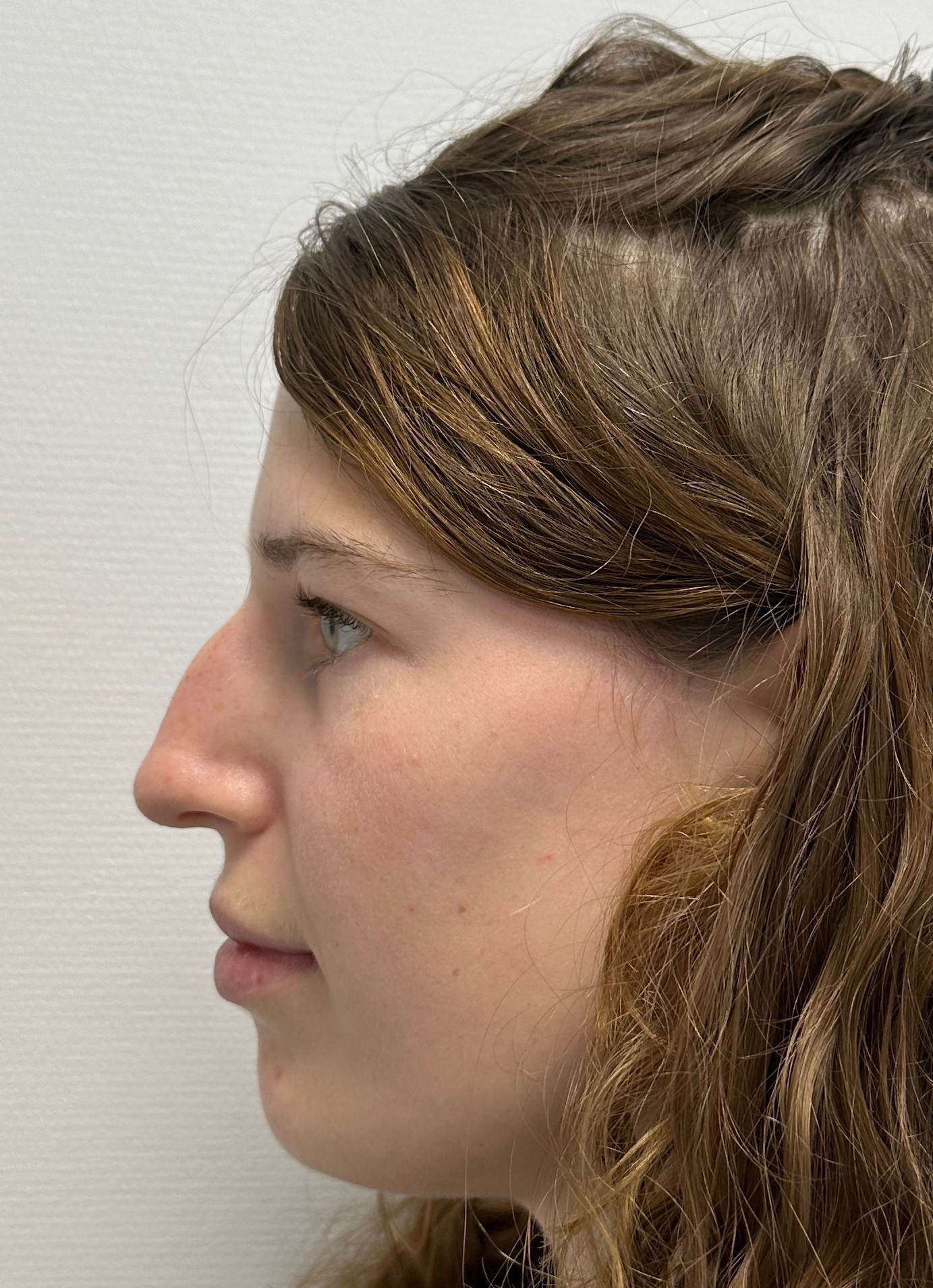 Nose correction before