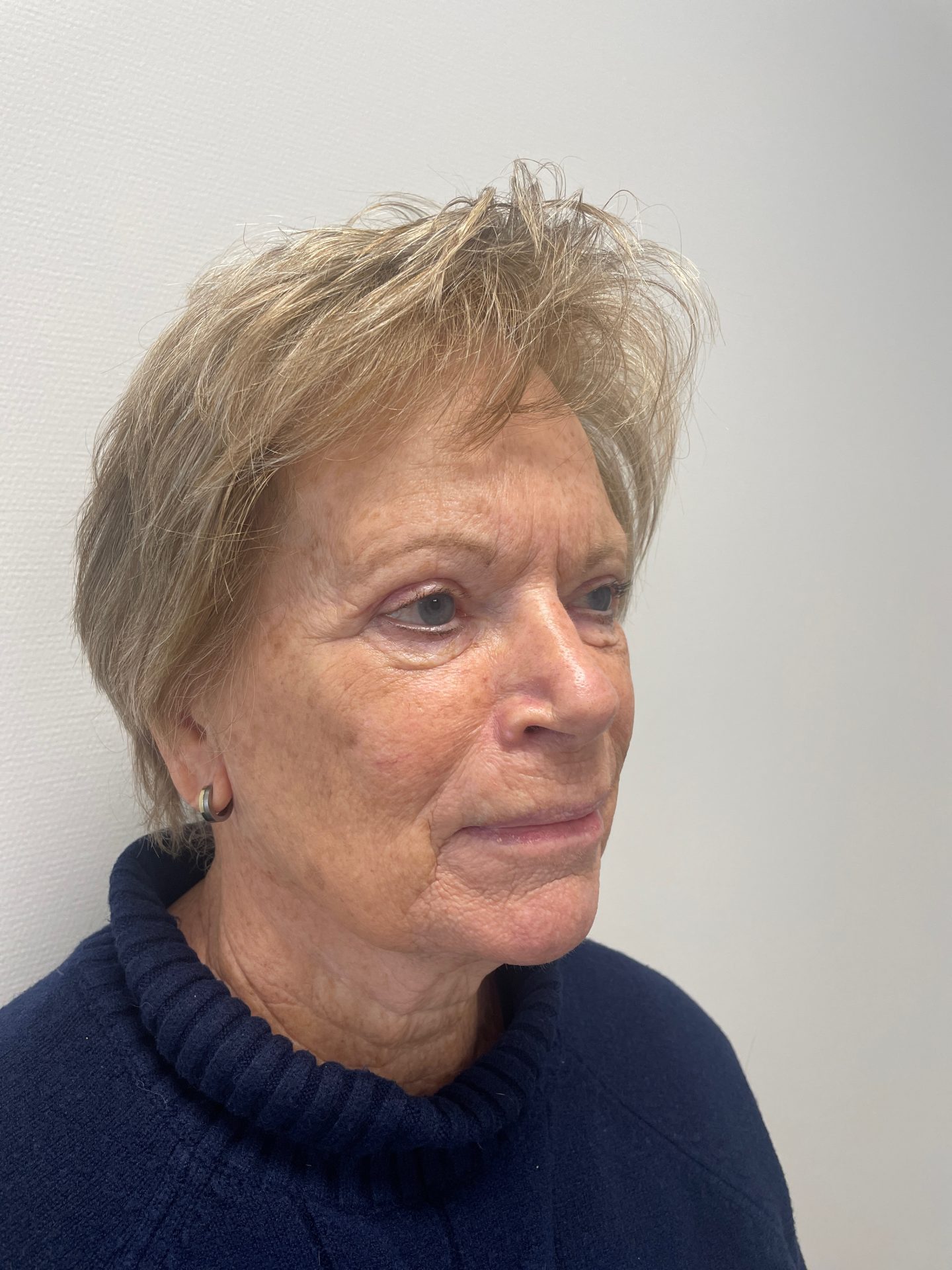 Eyelid correction after