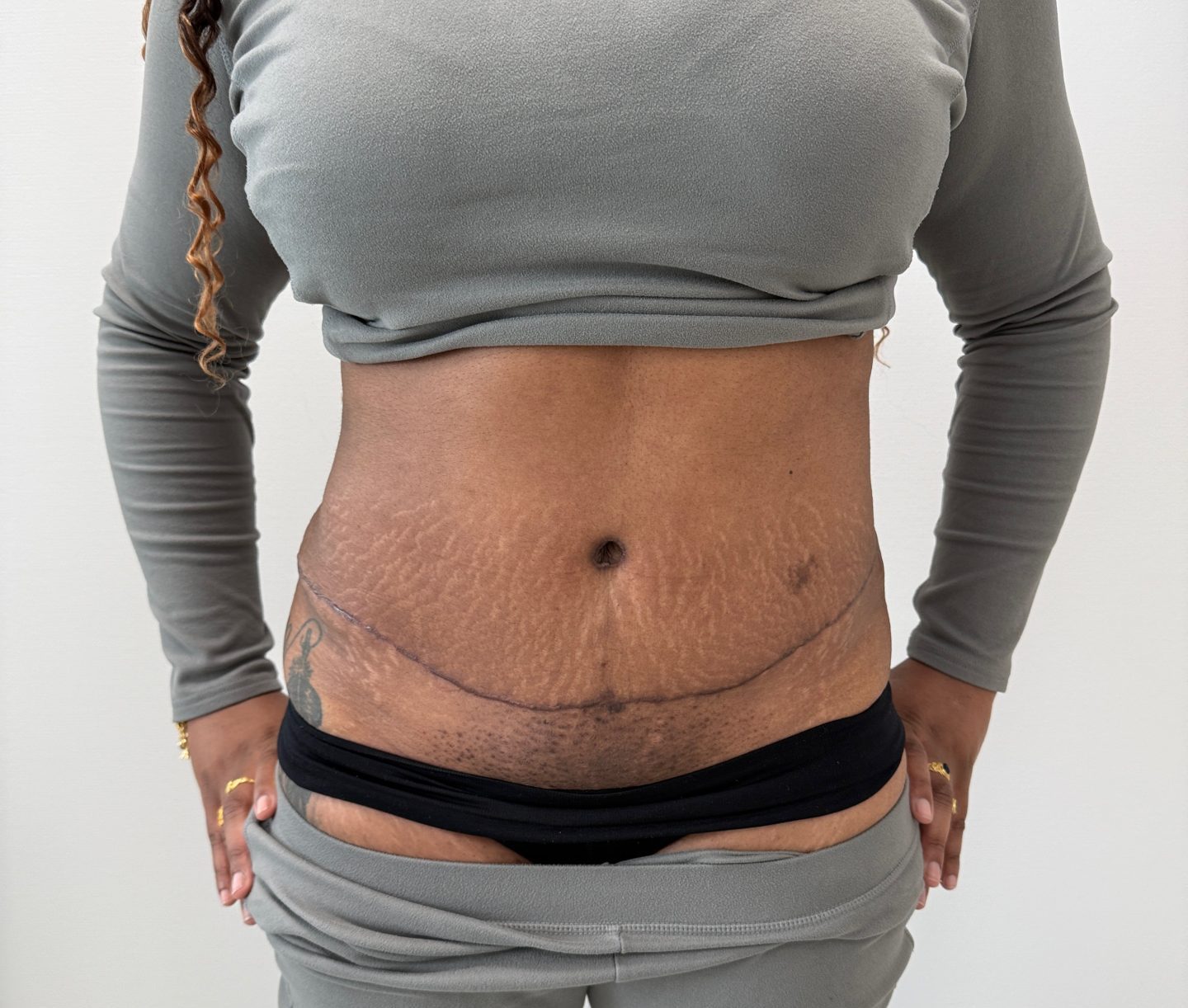 Tummy tuck after