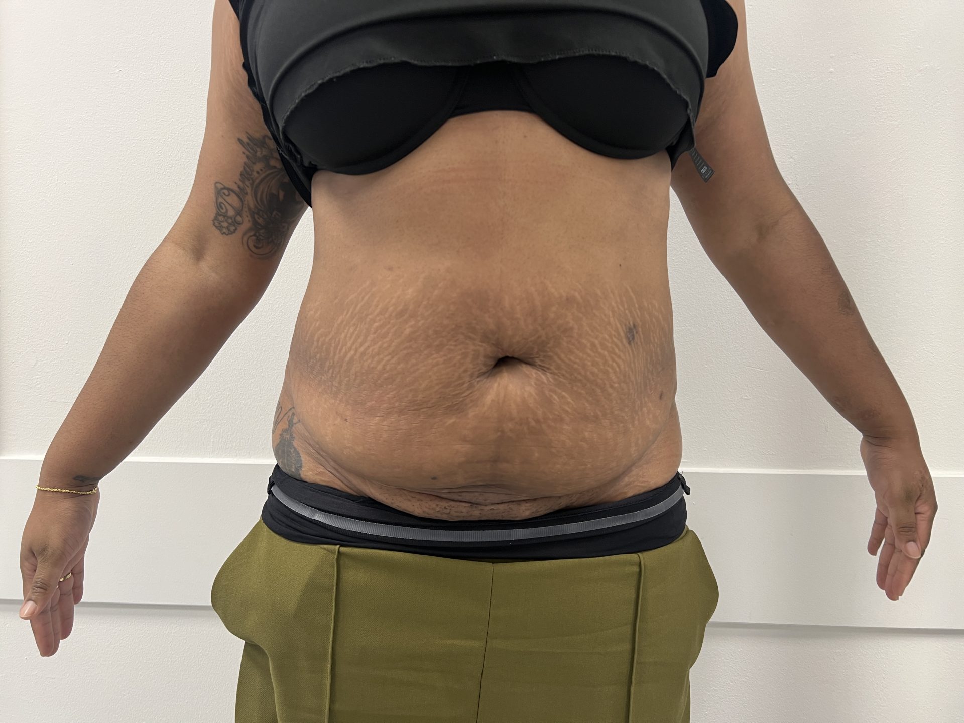 Tummy tuck before