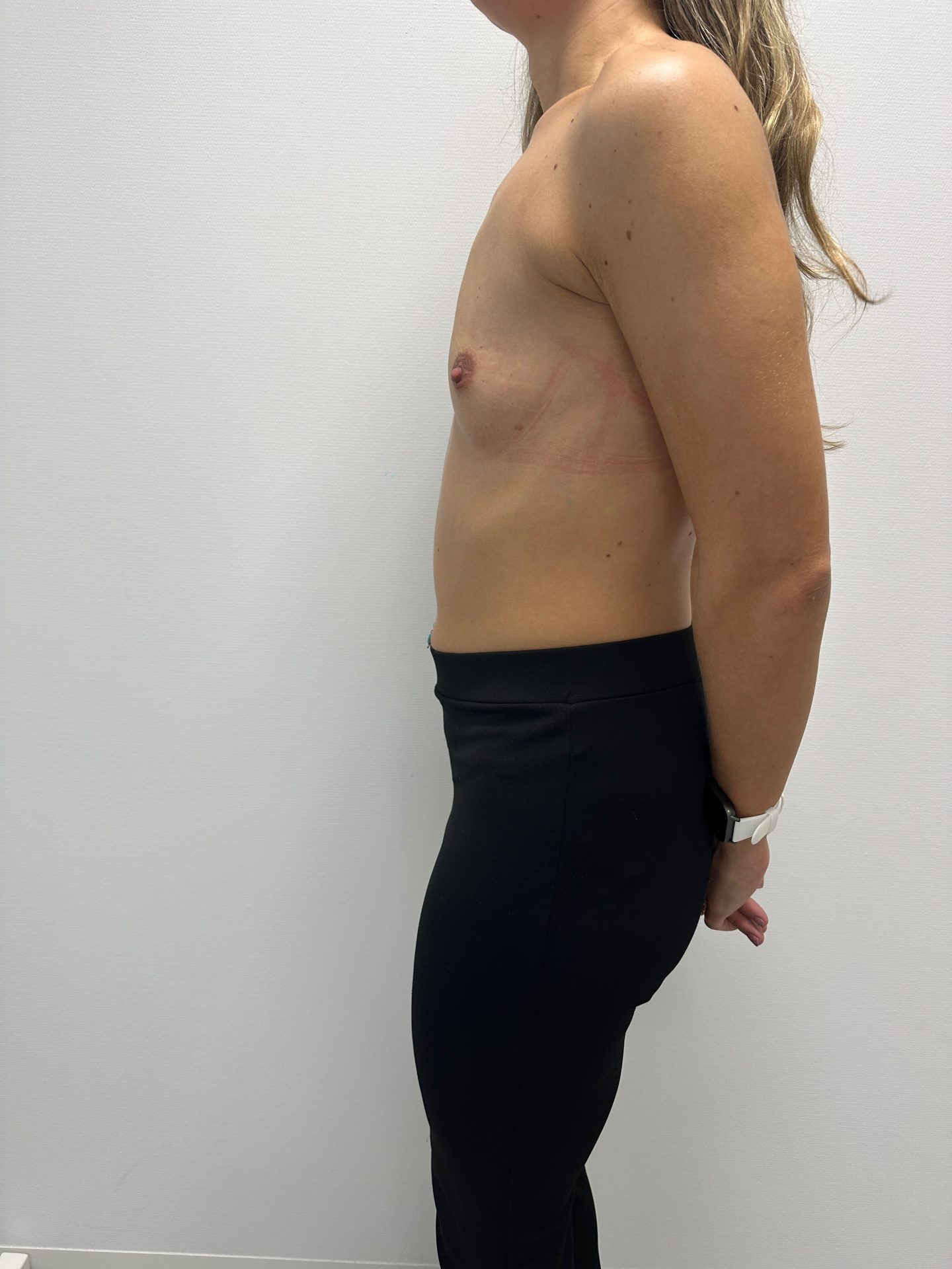 Breast augmentation before