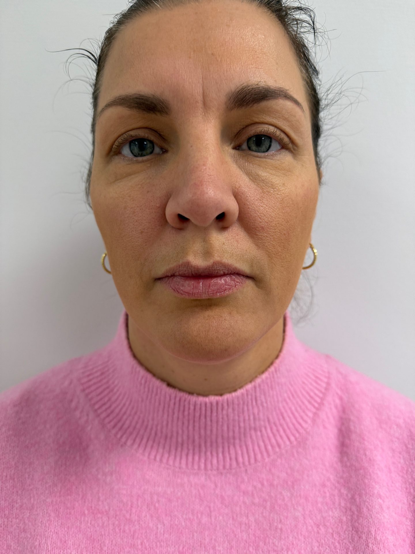 Eyelid correction after