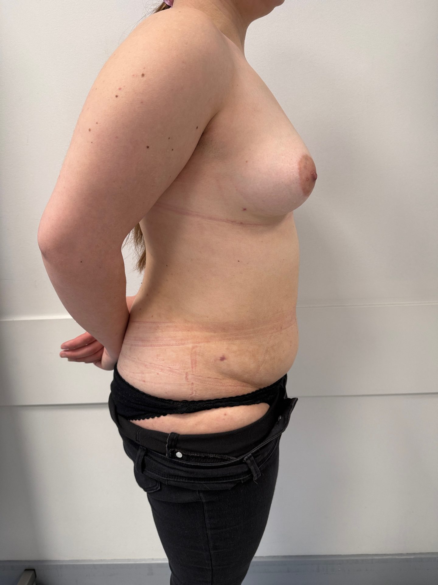 Lipofilling after