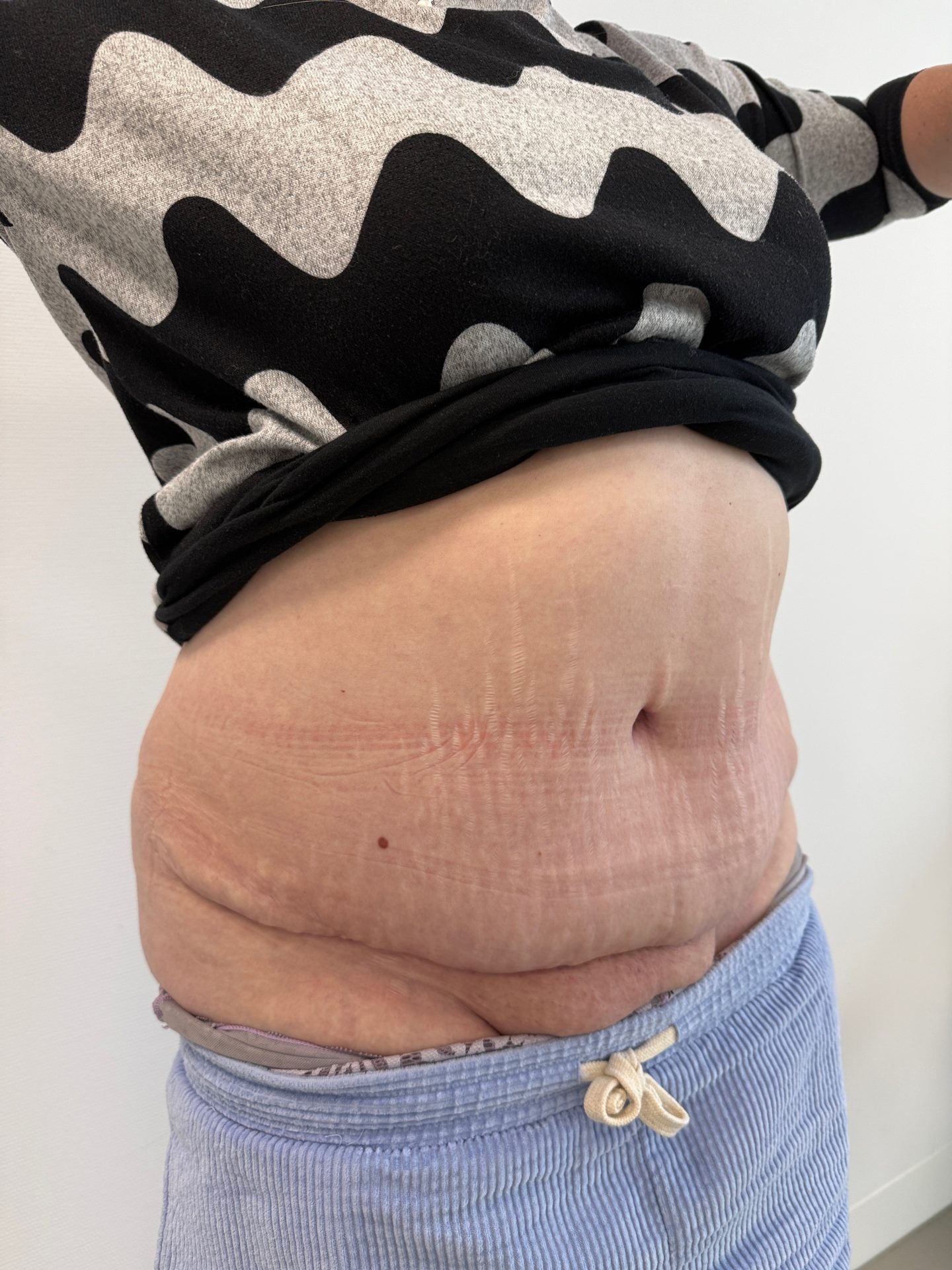 Tummy tuck after