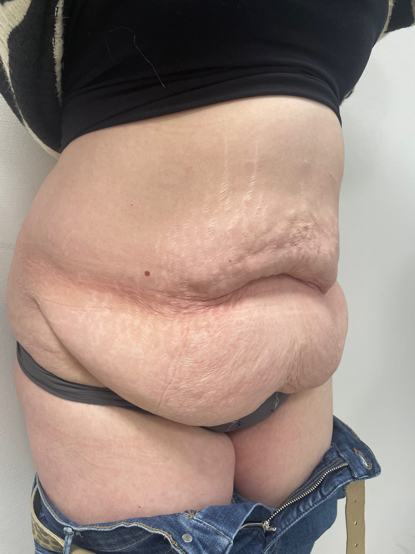 Tummy tuck before