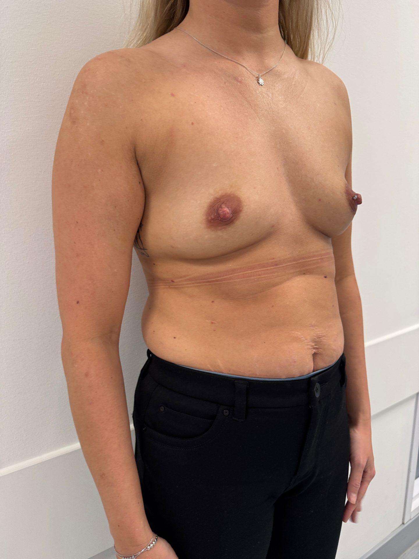 Breast augmentation before