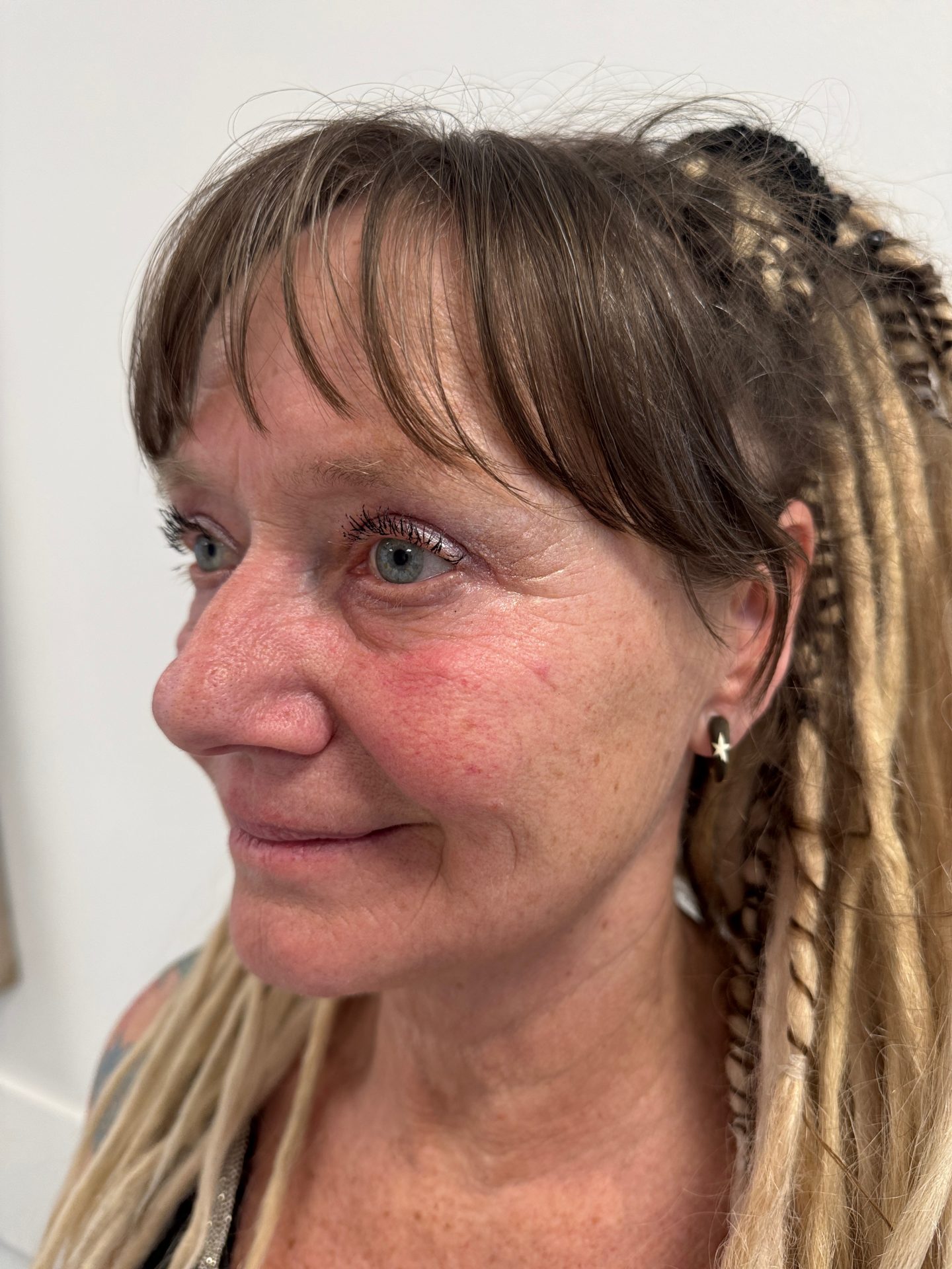Eyelid correction after