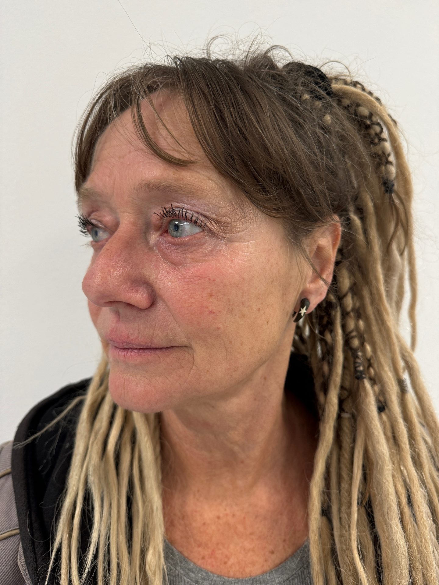 Eyelid correction before