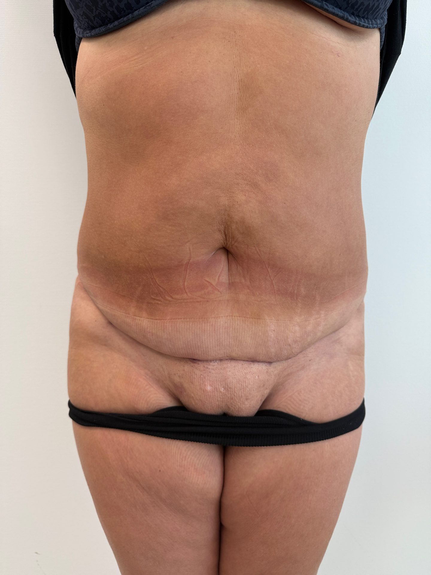Tummy tuck after