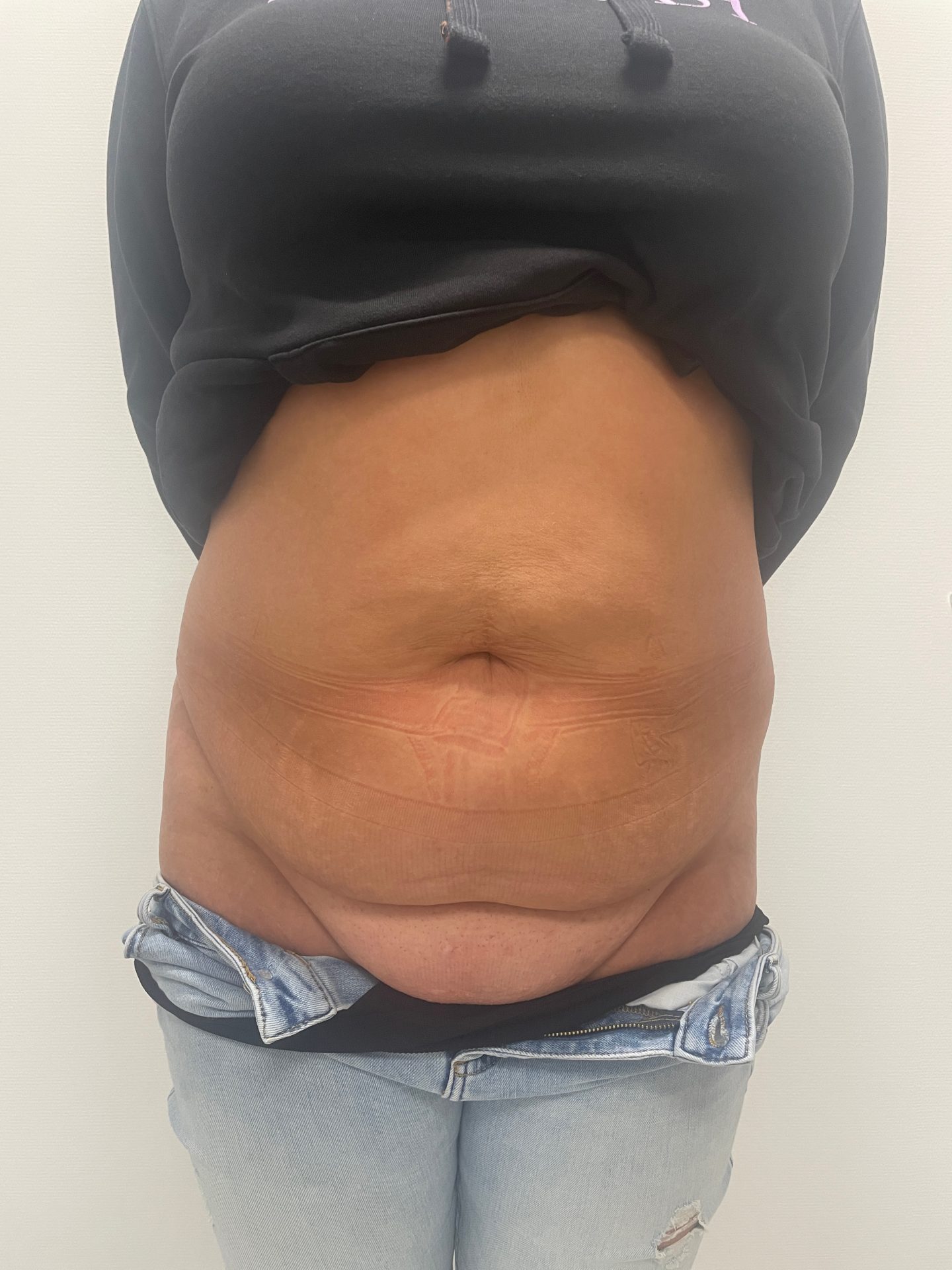 Tummy tuck before