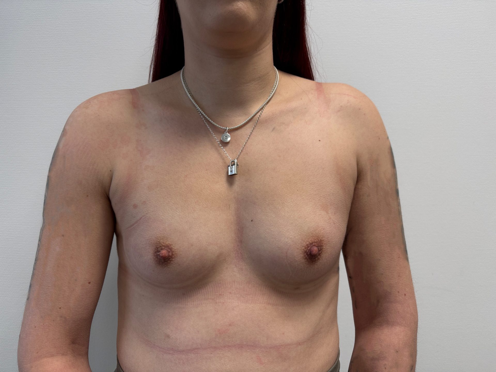 Breast augmentation before