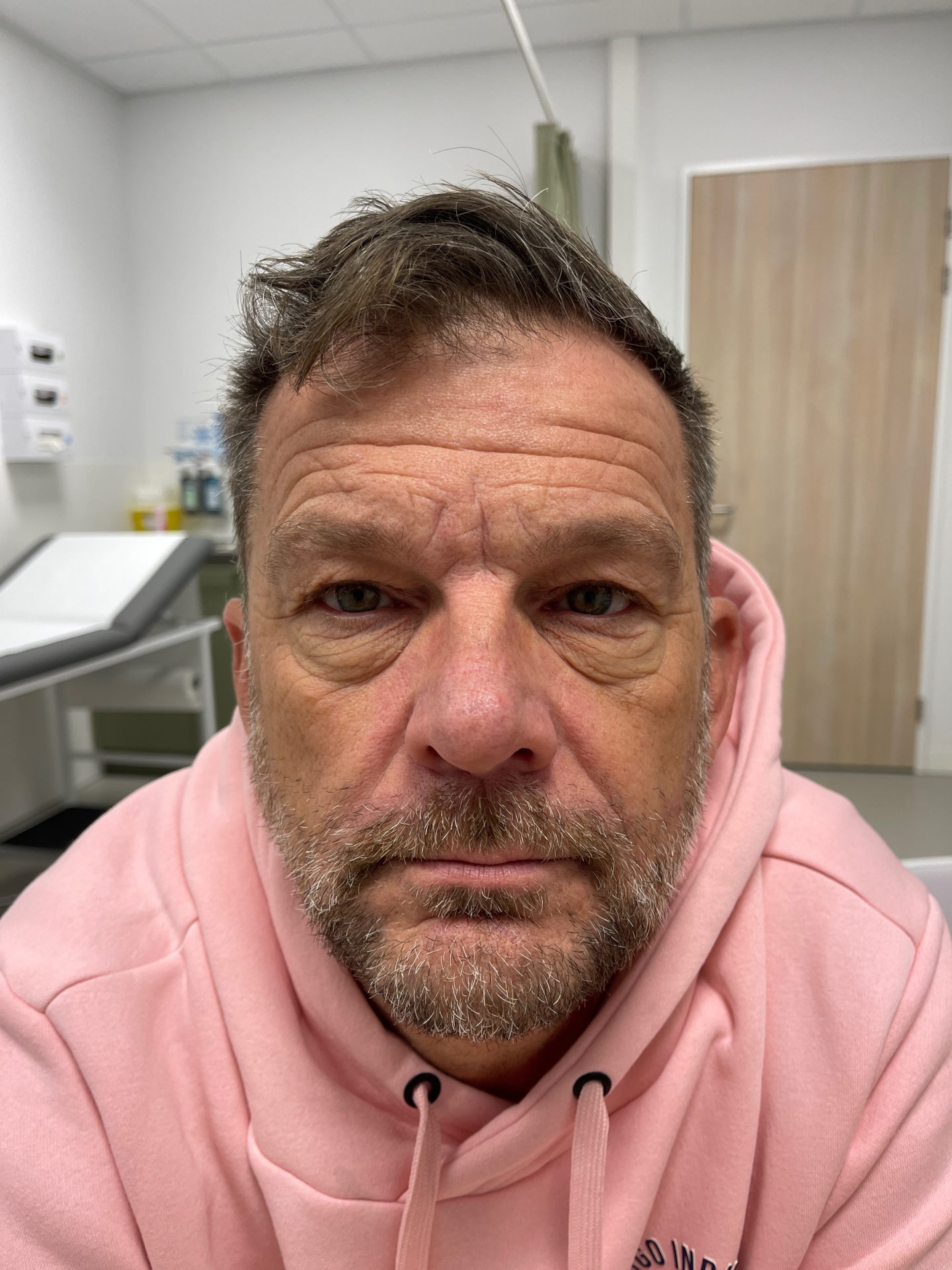 Eyelid correction before