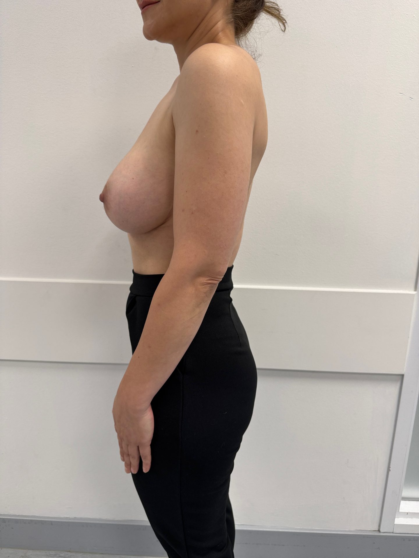 Breast augmentation after