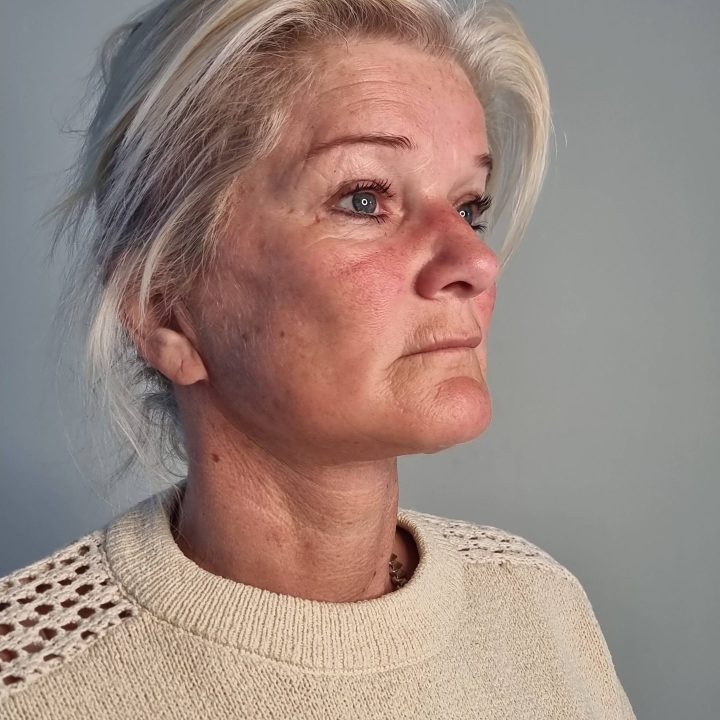 Neck facelift after
