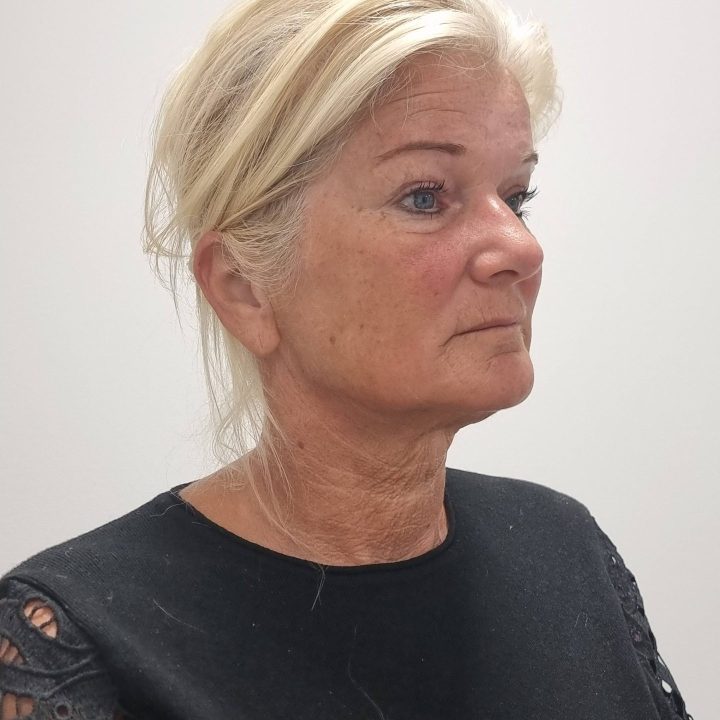 Neck facelift before