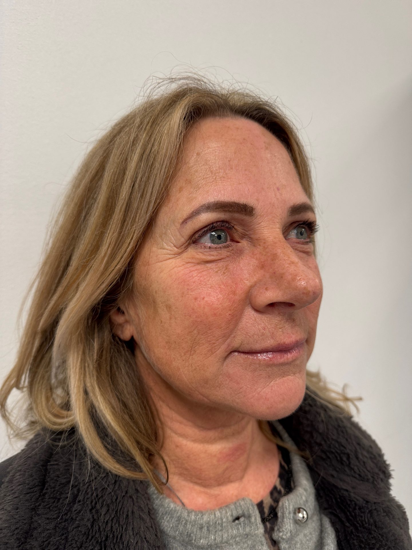 Eyelid correction before