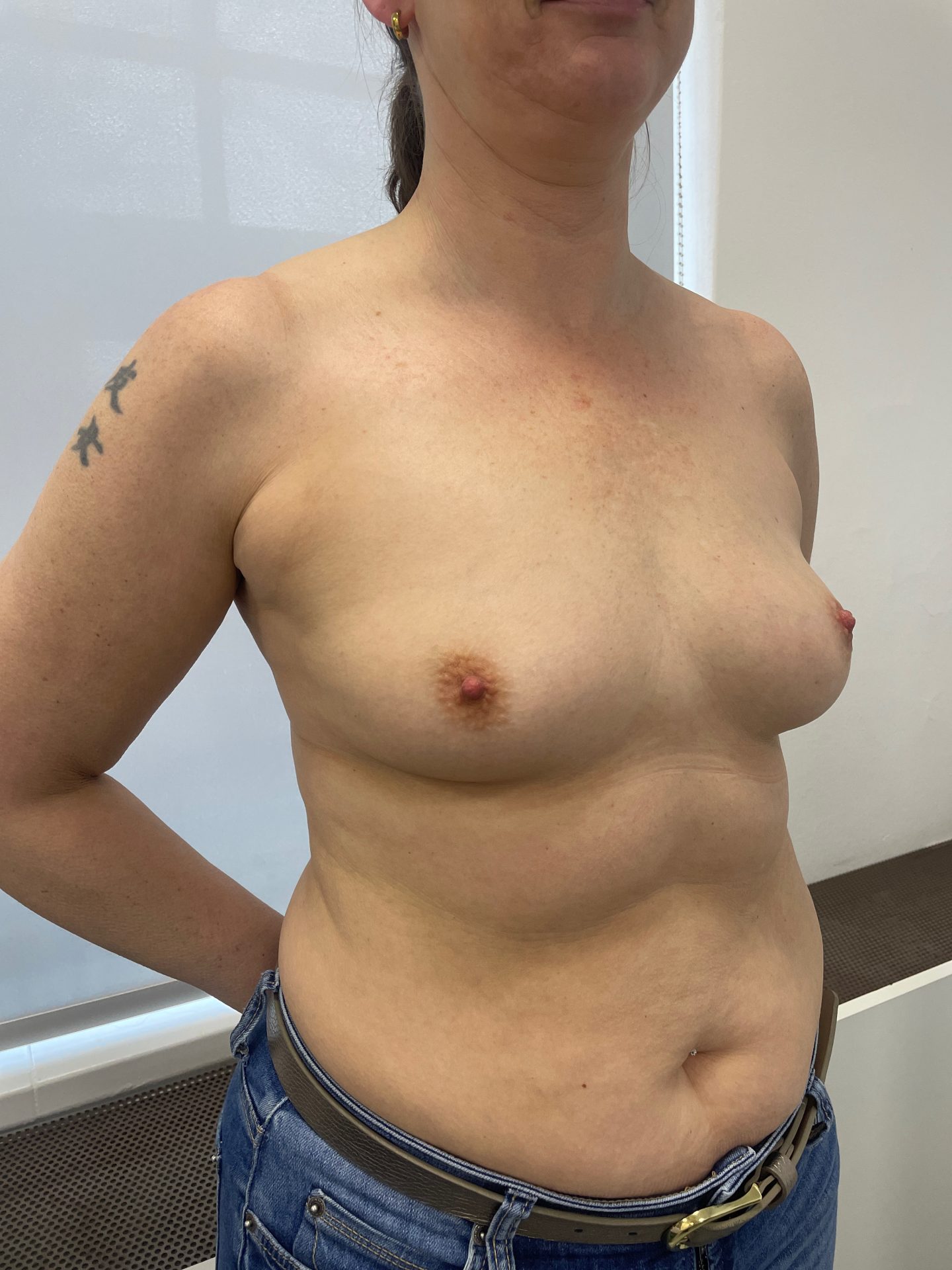 Breast augmentation before