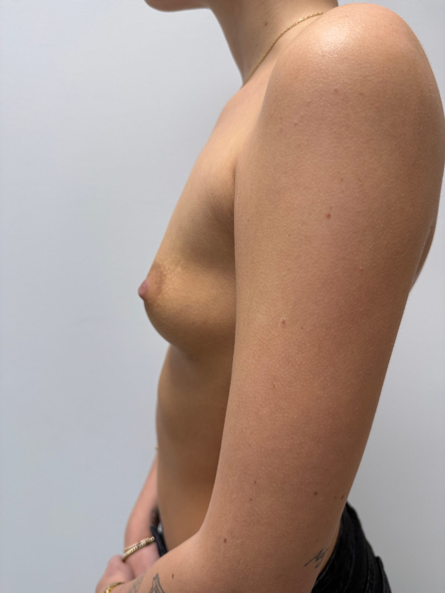 Breast augmentation before