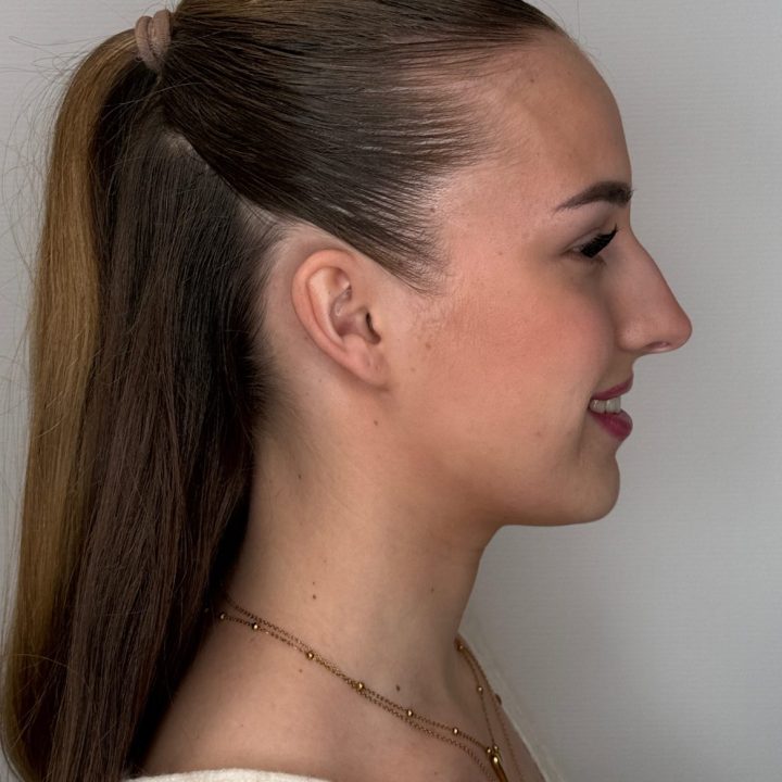 Nose correction before