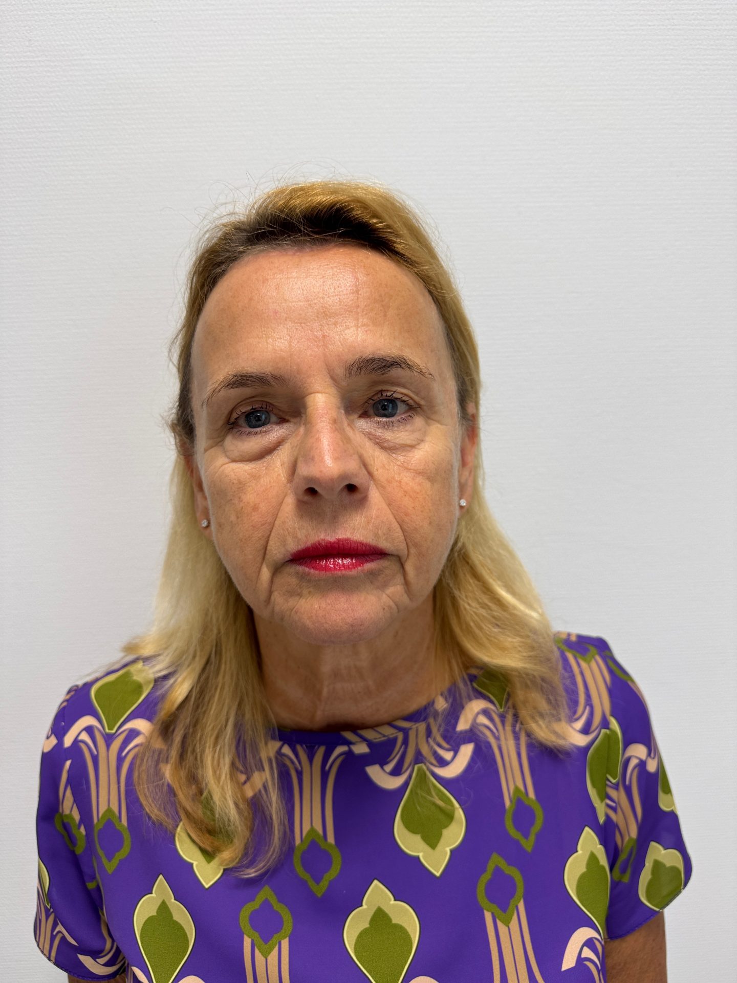 Eyelid correction after