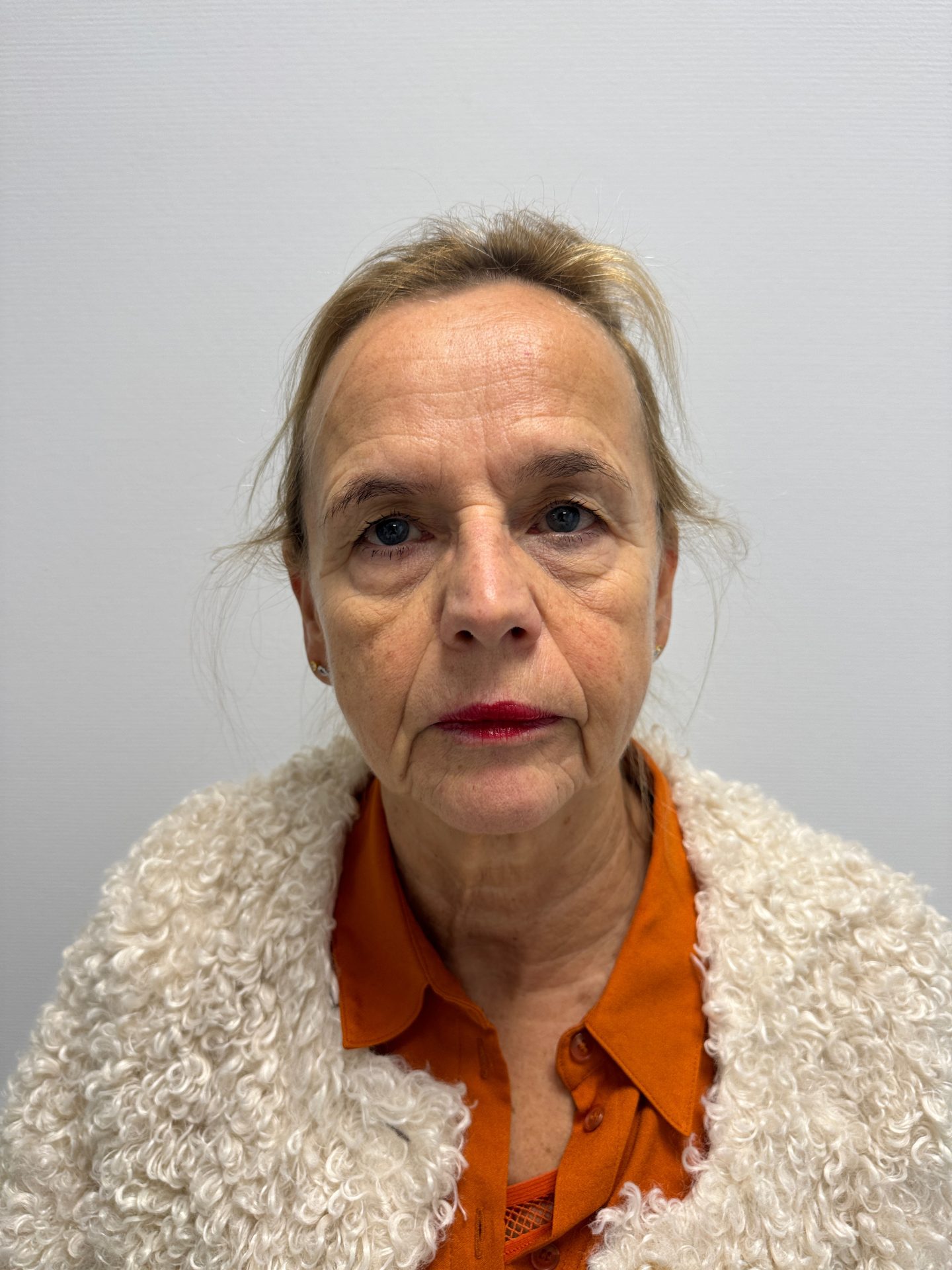 Eyelid correction before