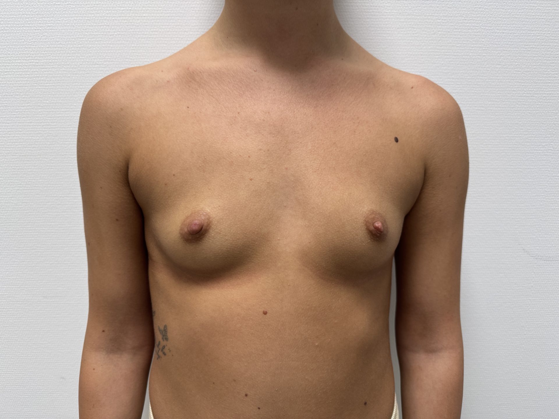 Breast augmentation before