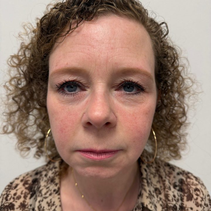Eyelid correction before