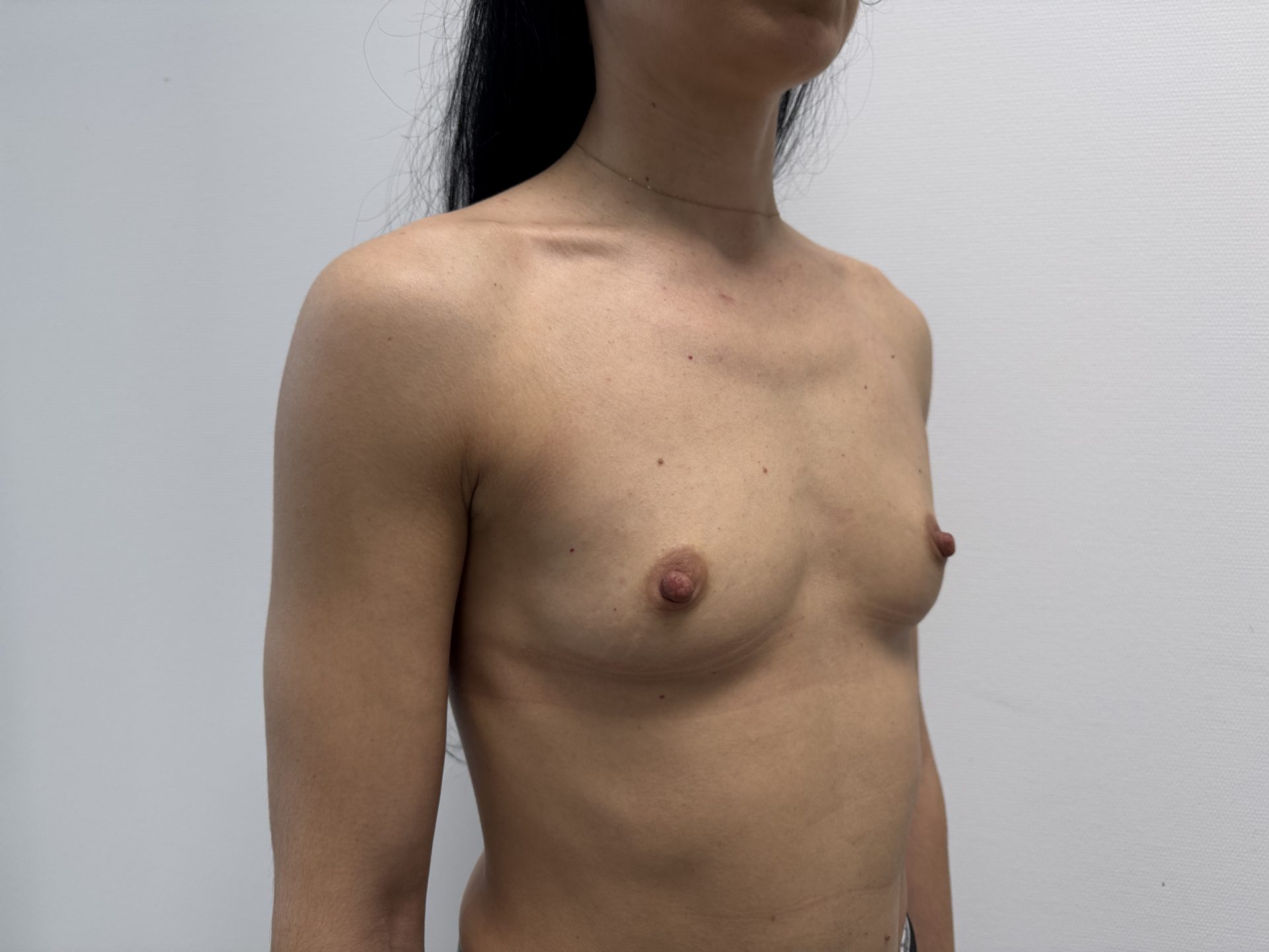 Breast augmentation before