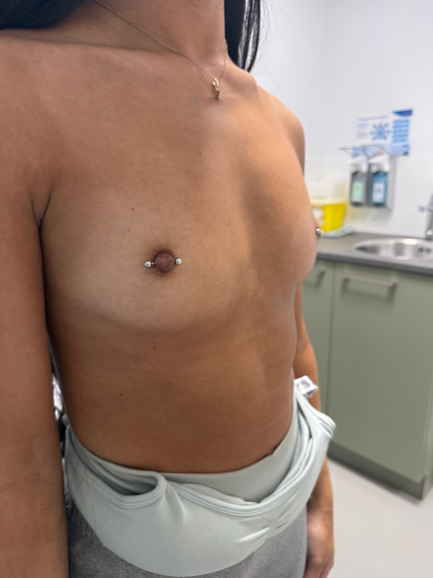 Breast augmentation before