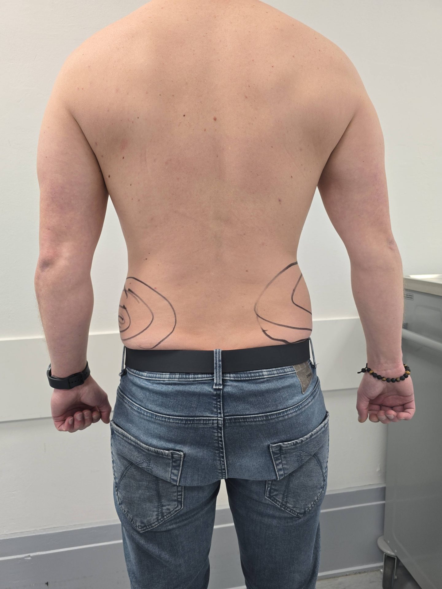 Liposuction before