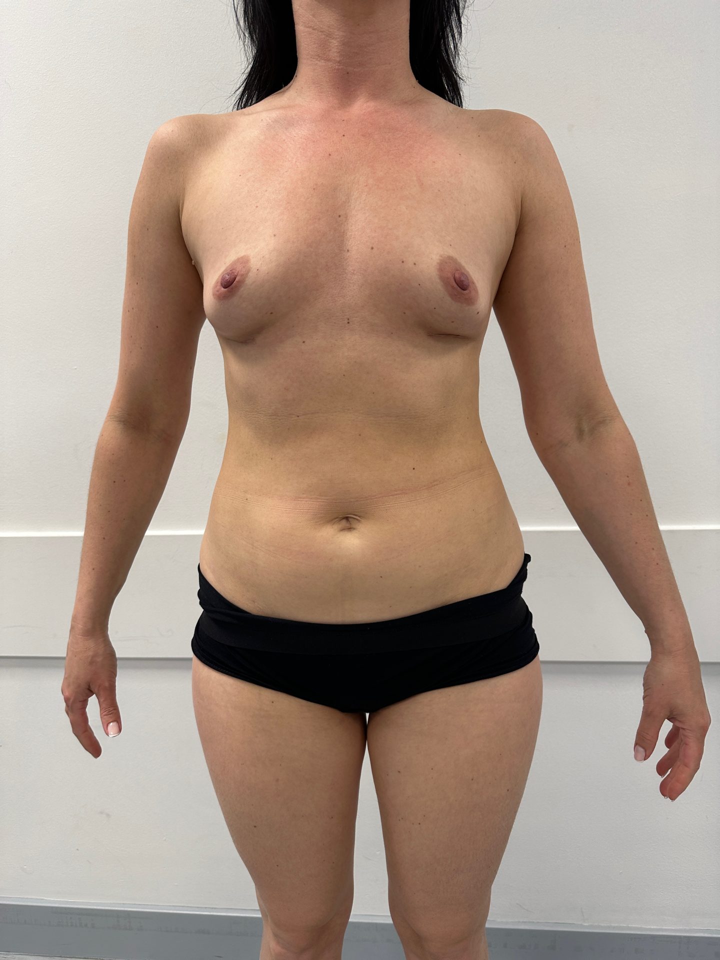 Lipofilling before