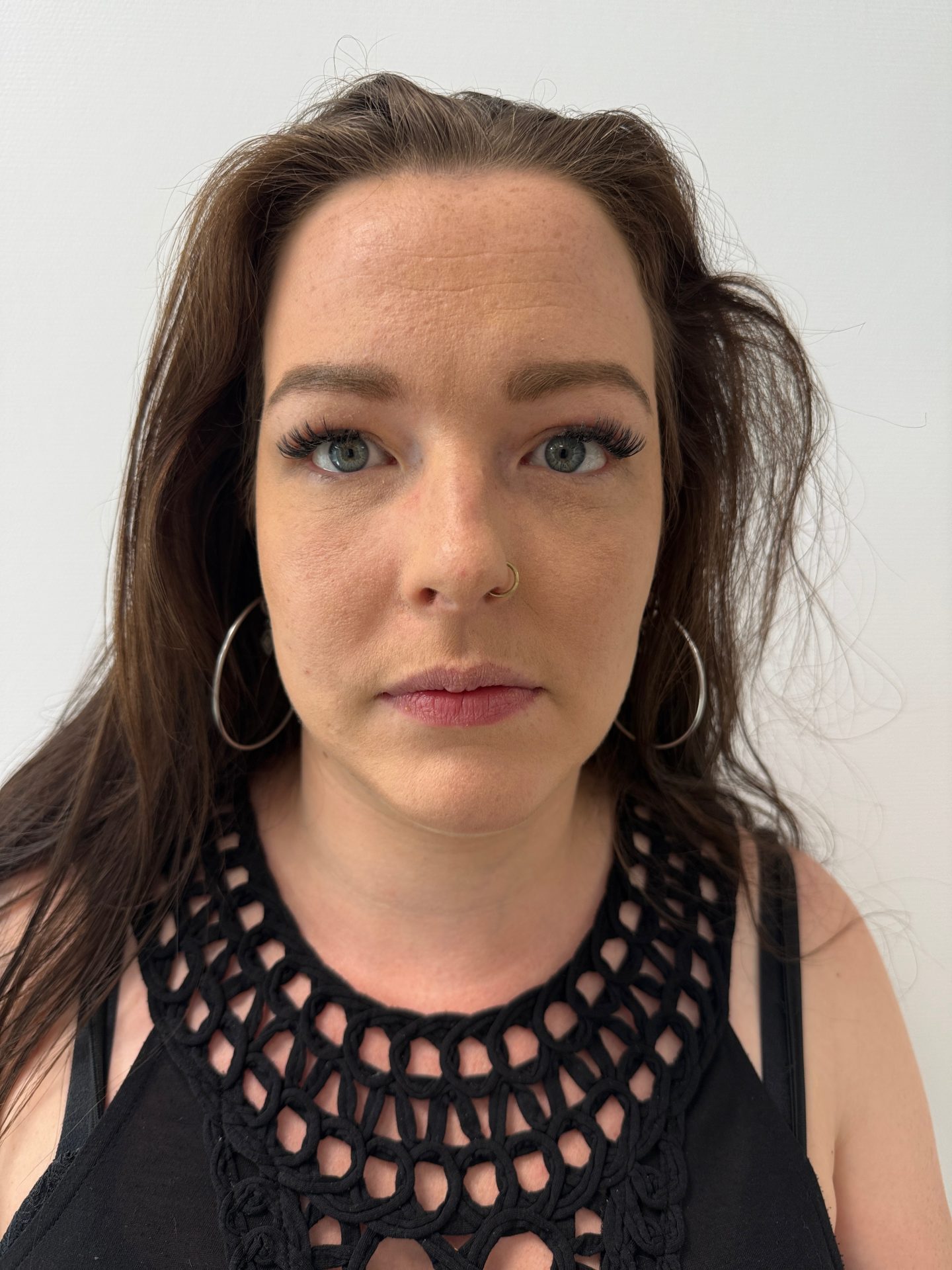 Eyelid correction after