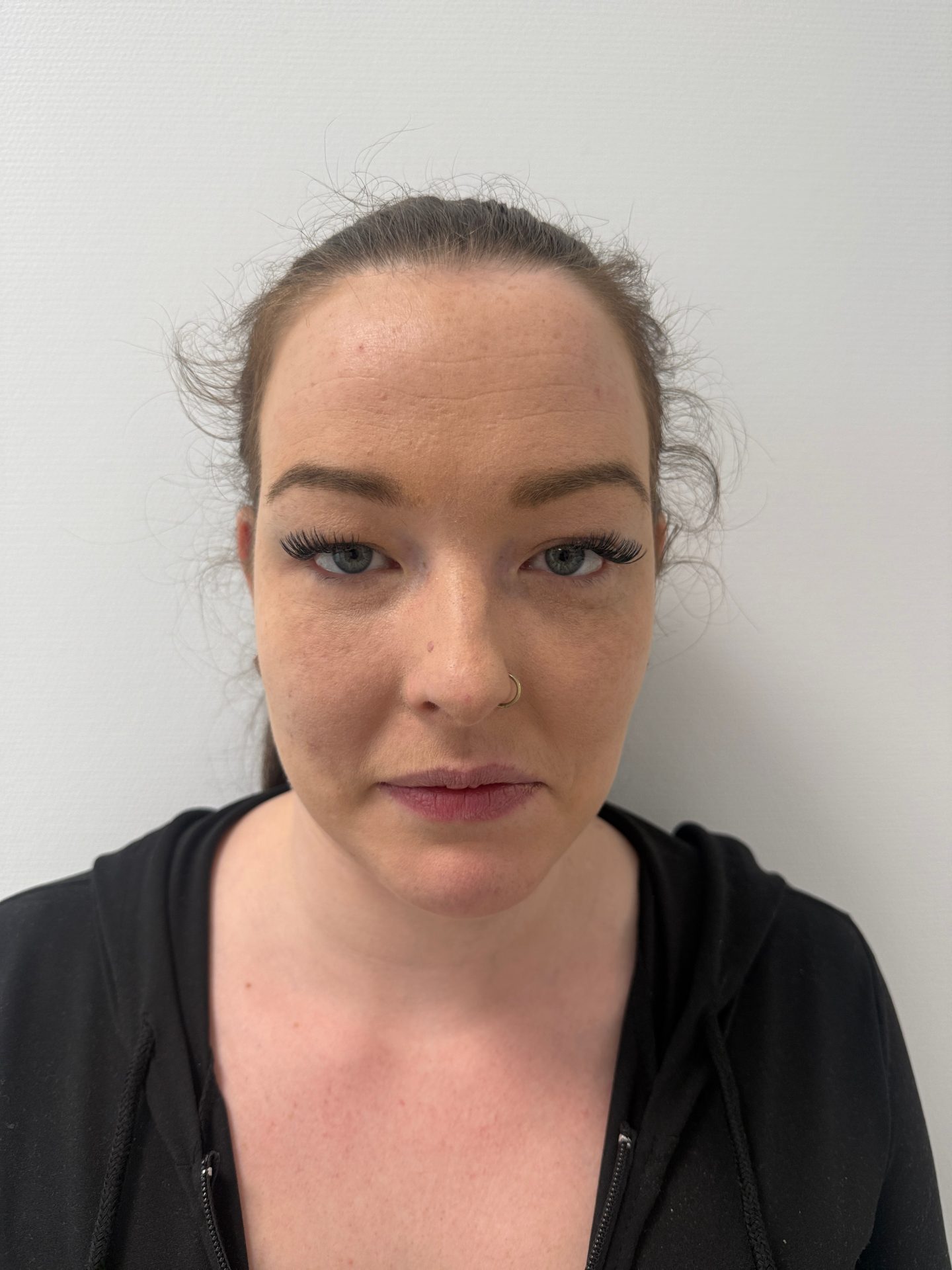 Eyelid correction before