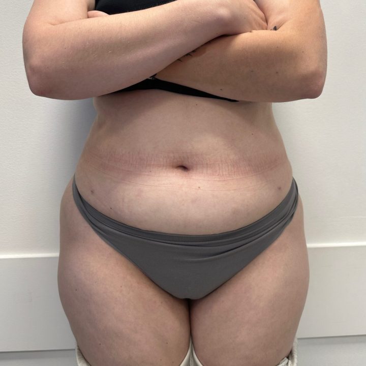 Liposuction after